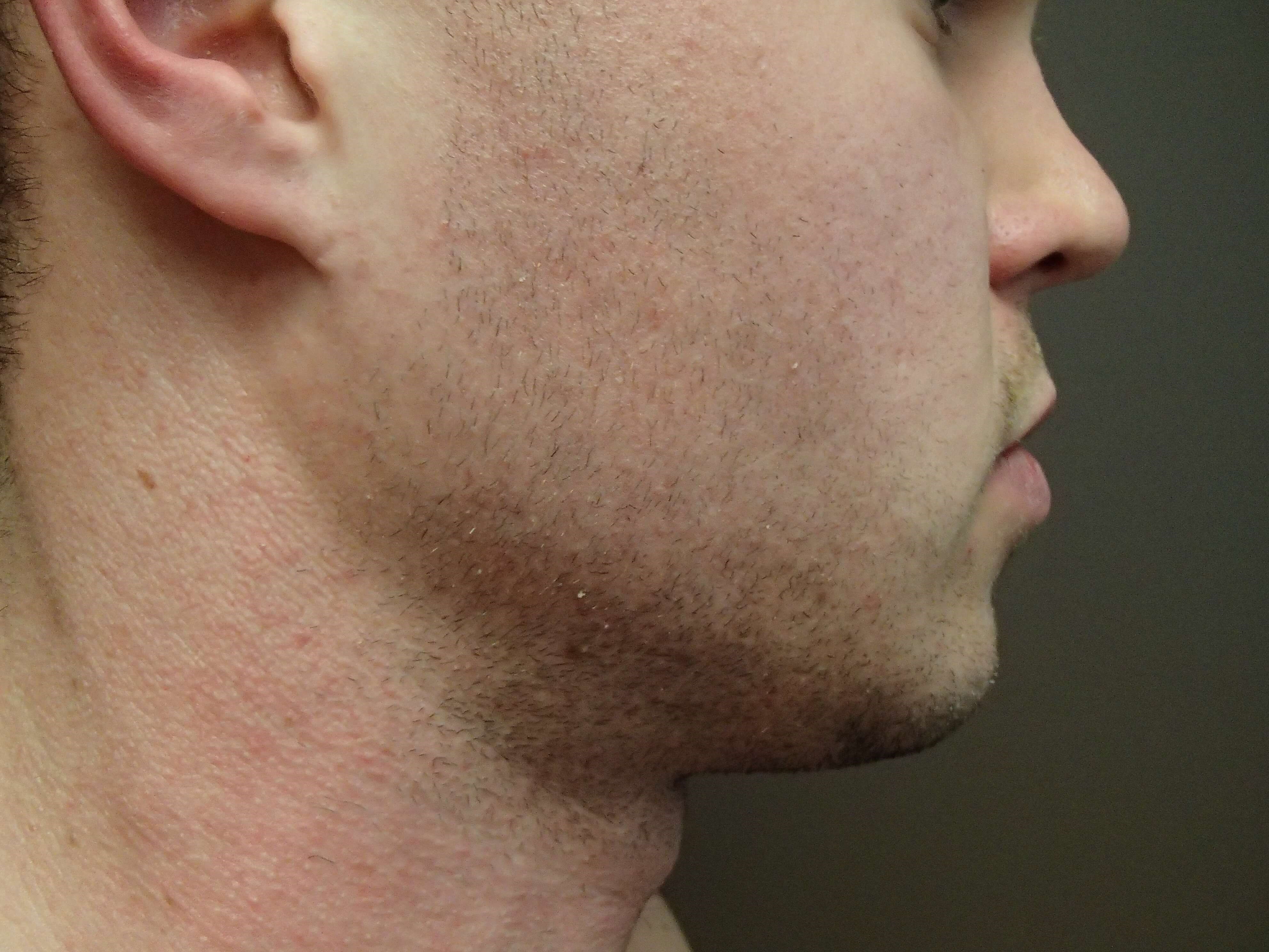Facial Contouring After