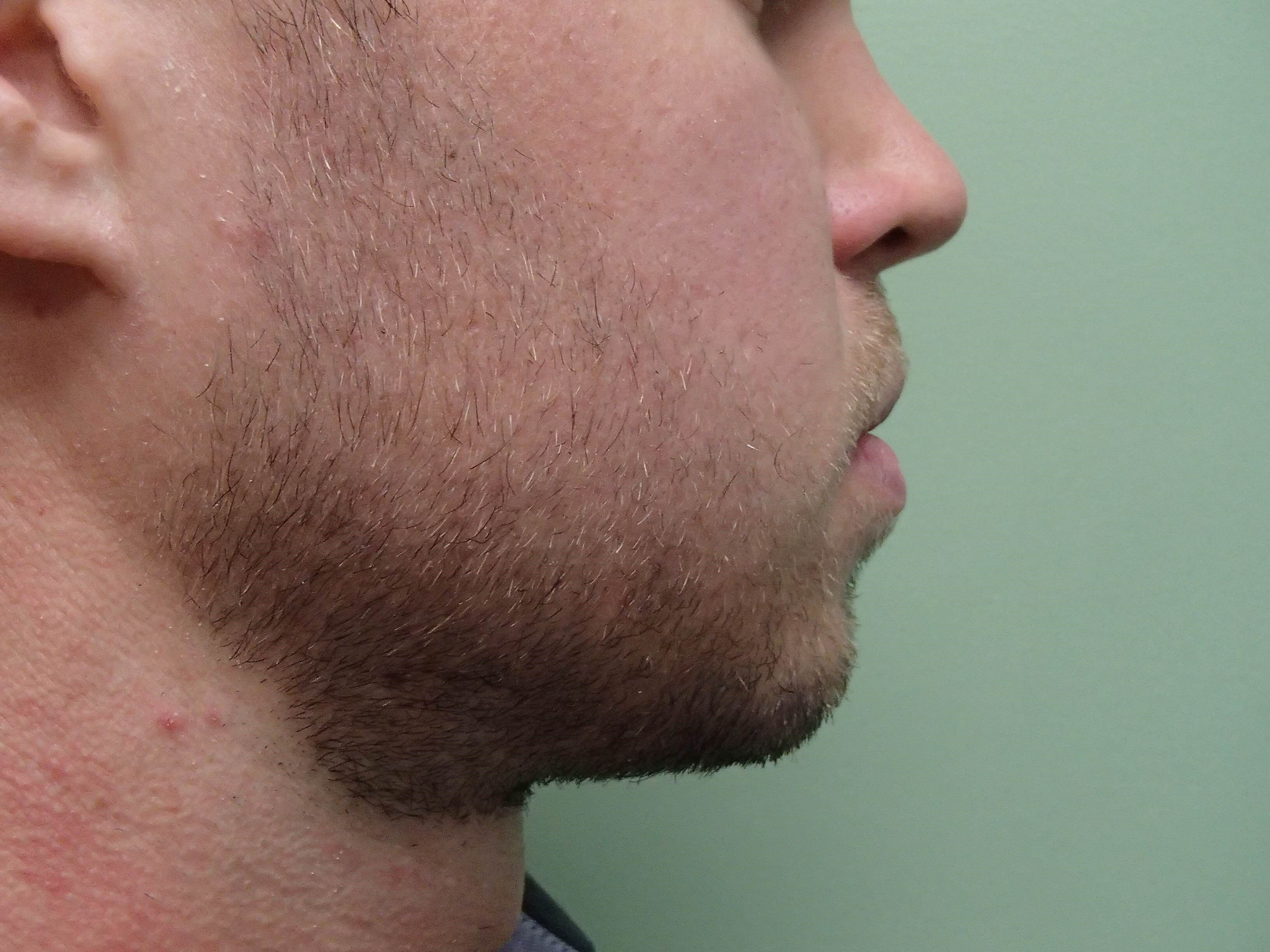Facial Contouring Before