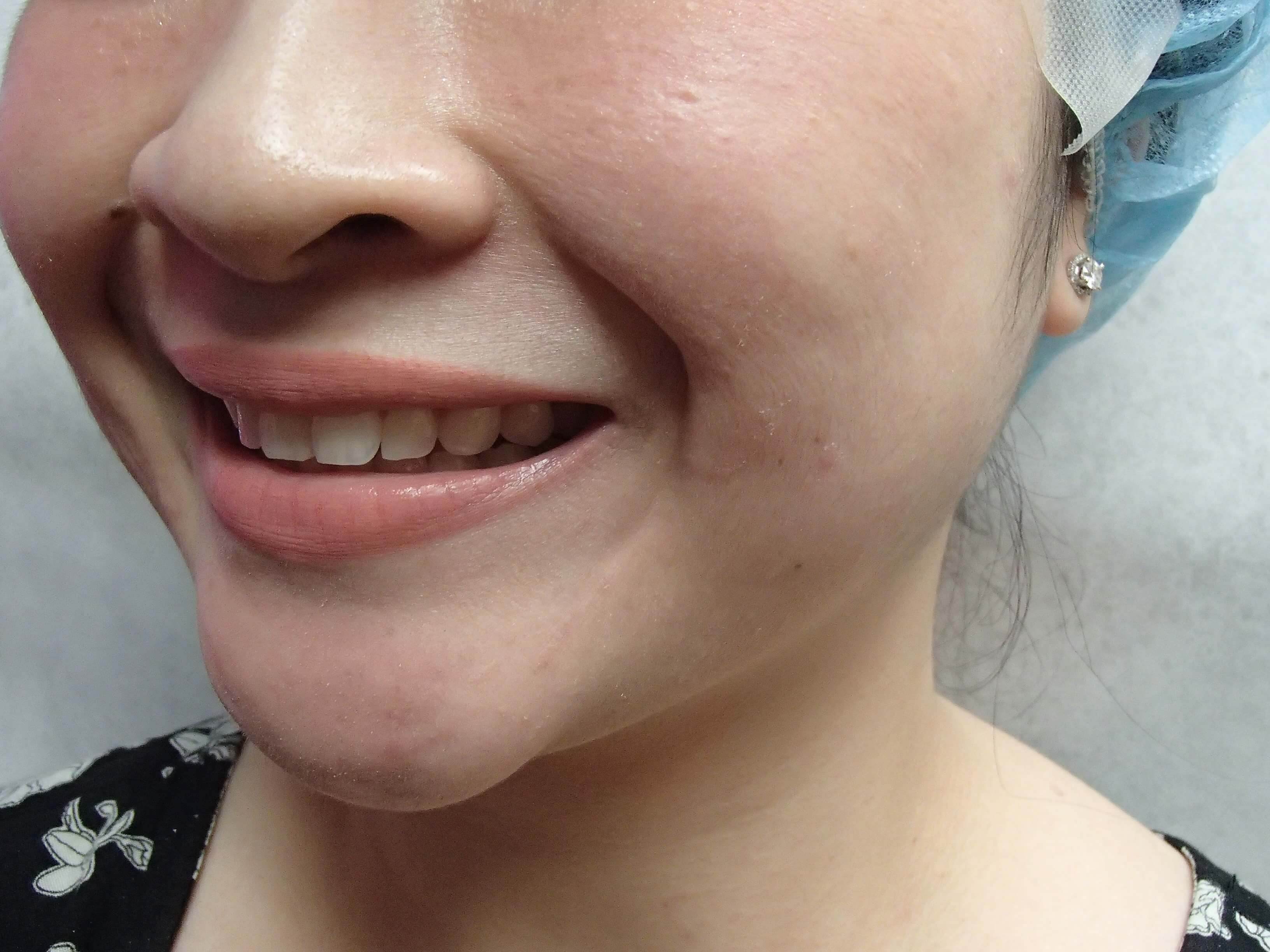 Timeless Dimple Before