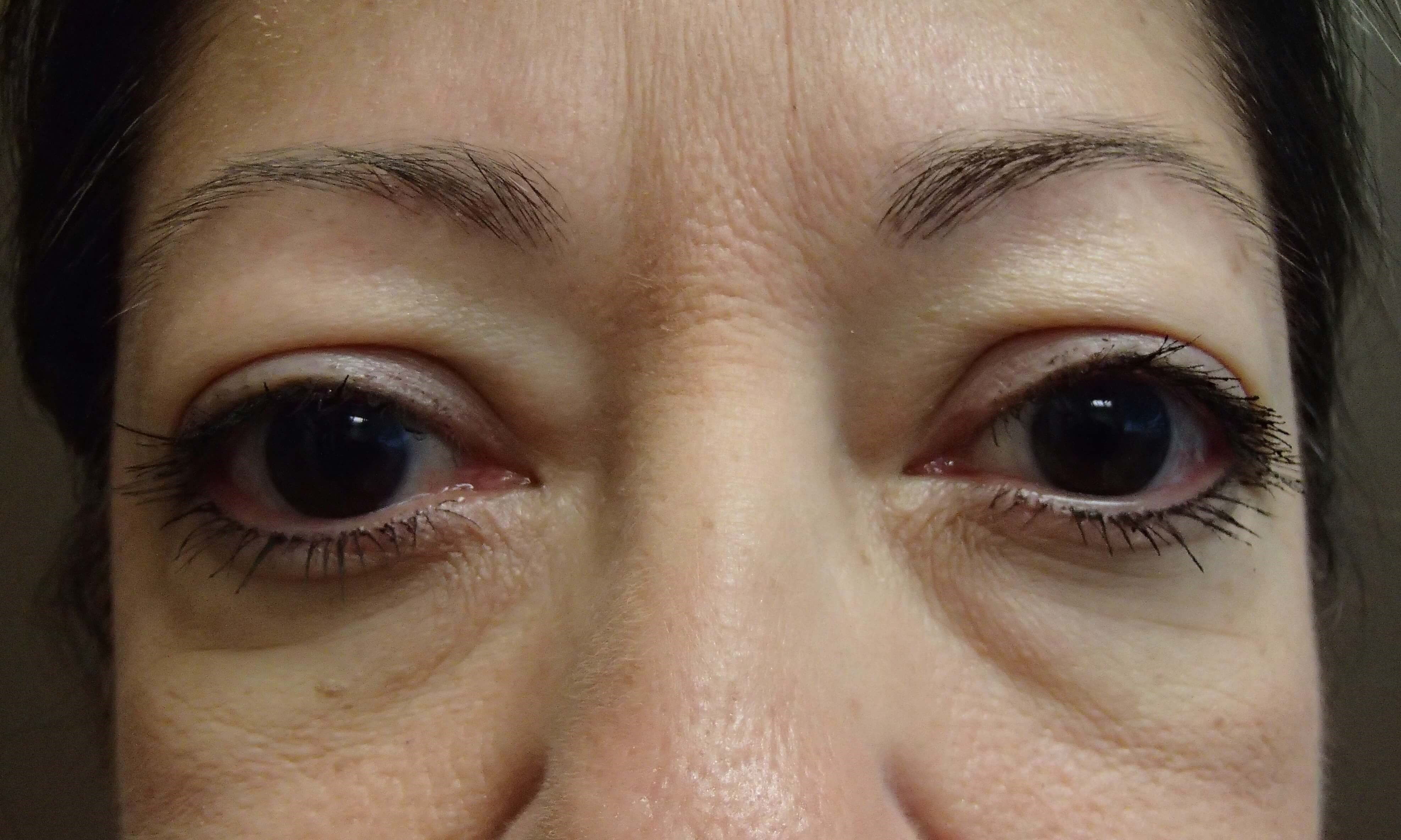 Blepharoplasty Before