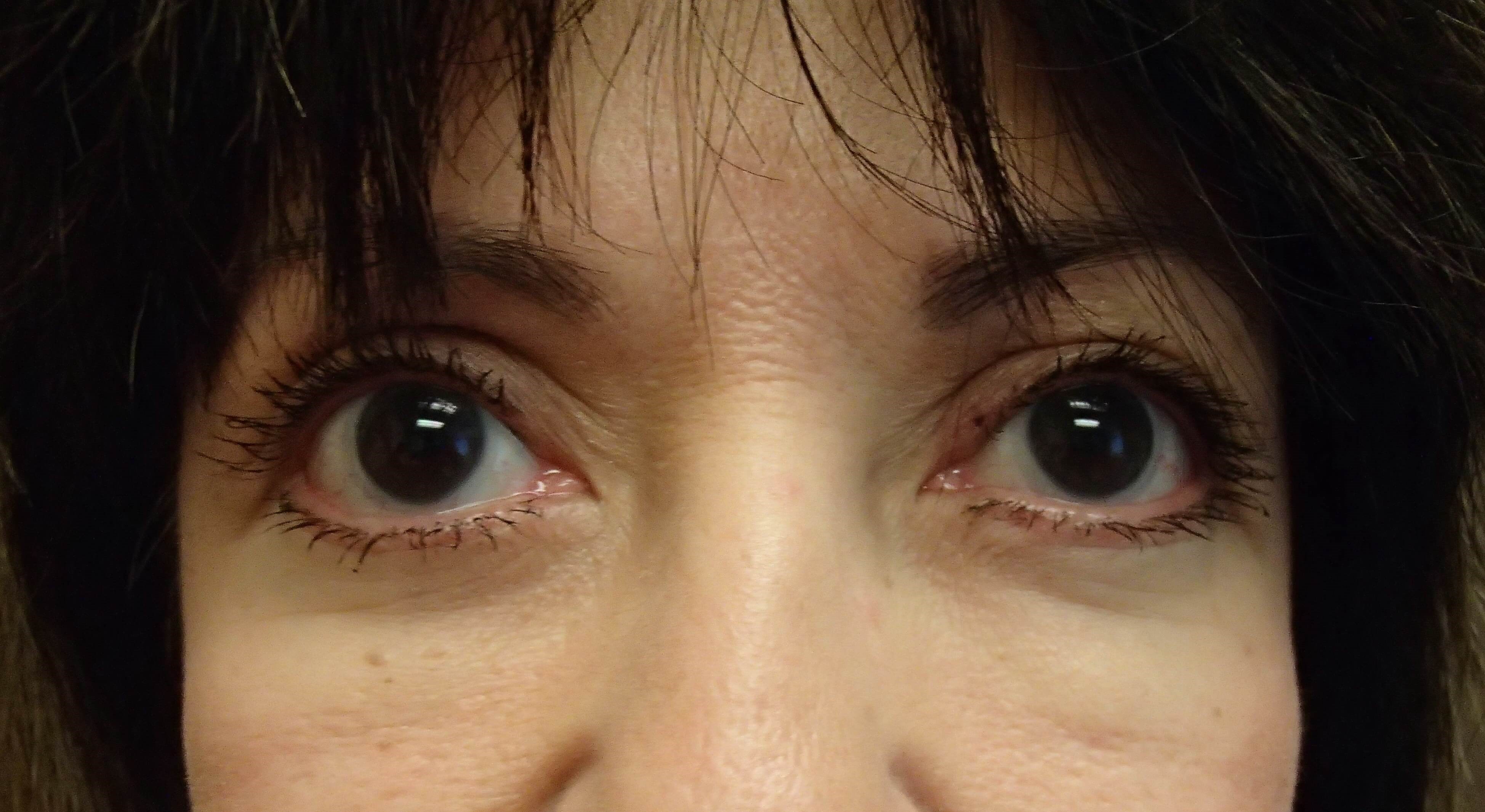 Blepharoplasty After