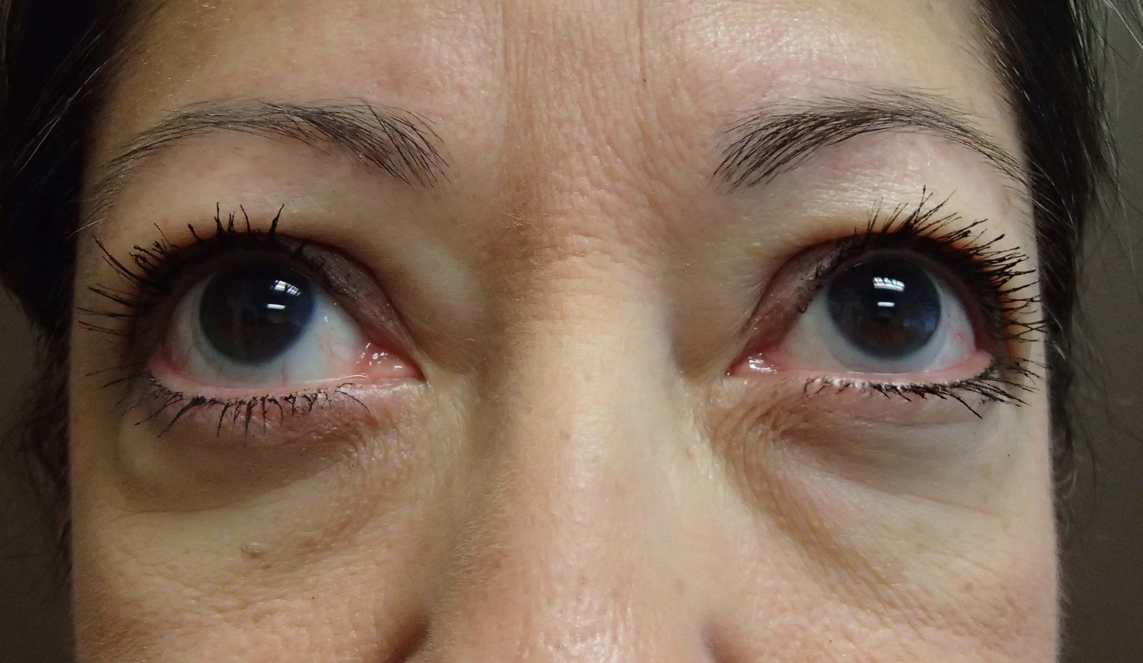 Blepharoplasty Before
