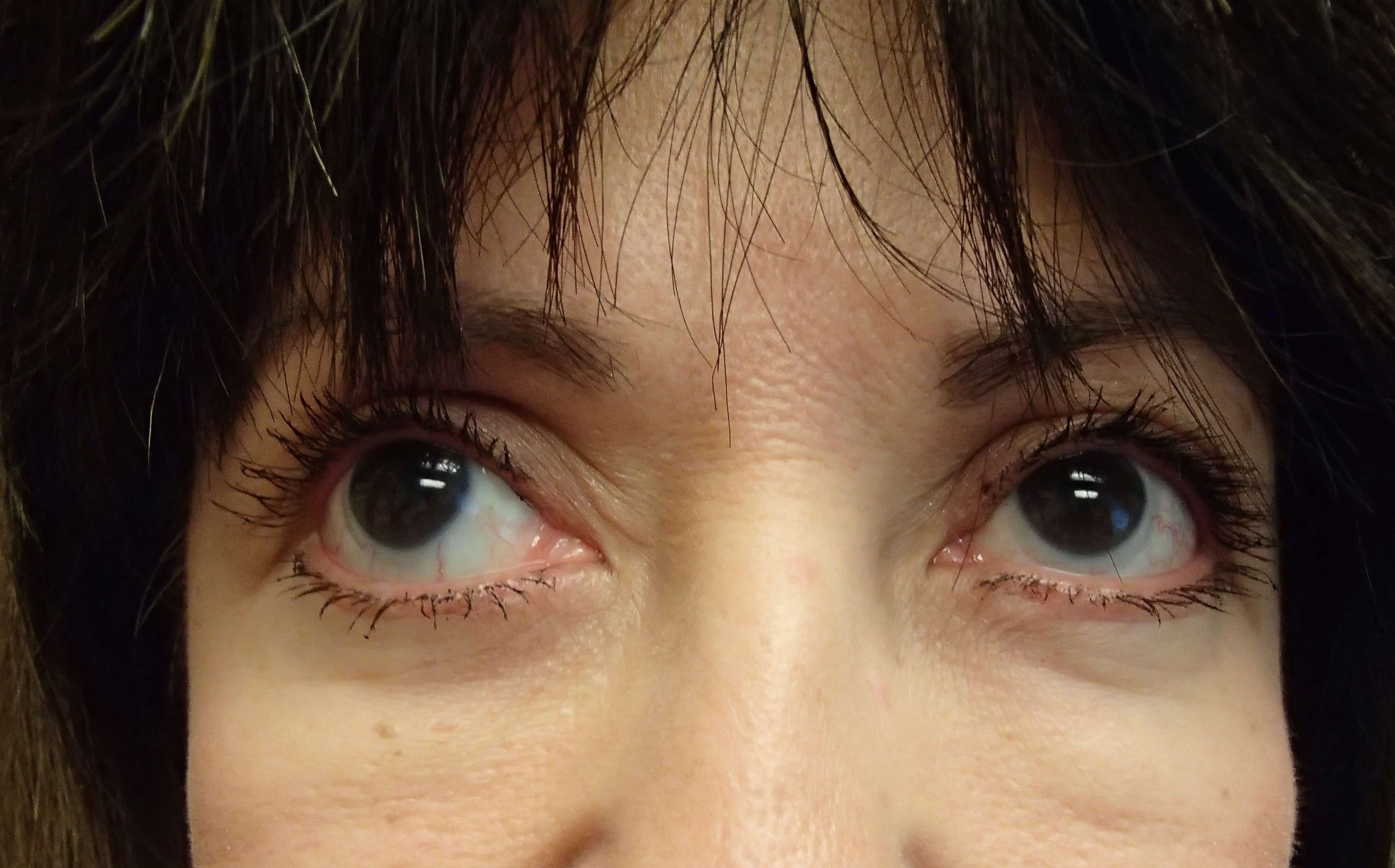 Blepharoplasty After