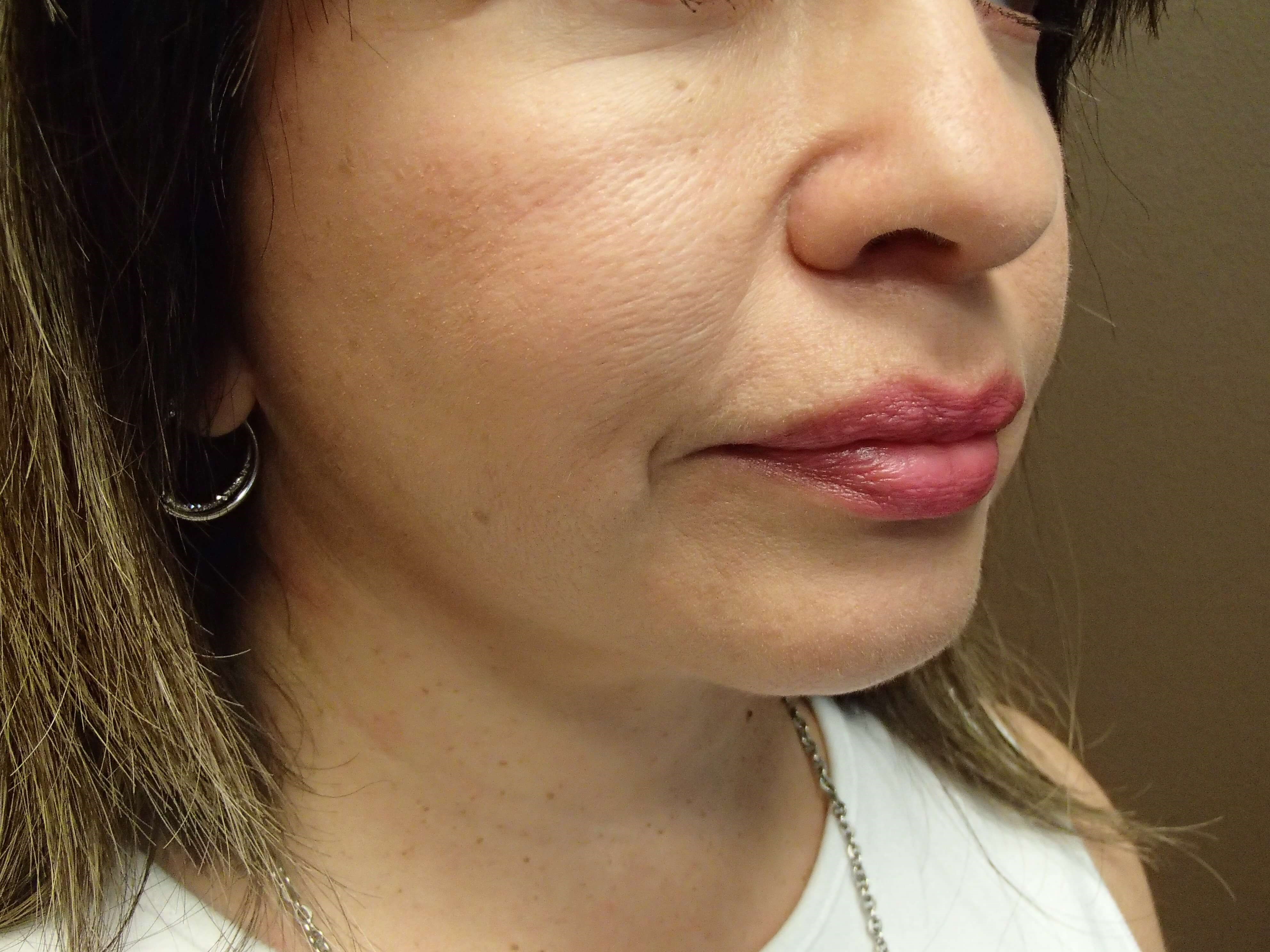 Facelift with Fat Transfer After