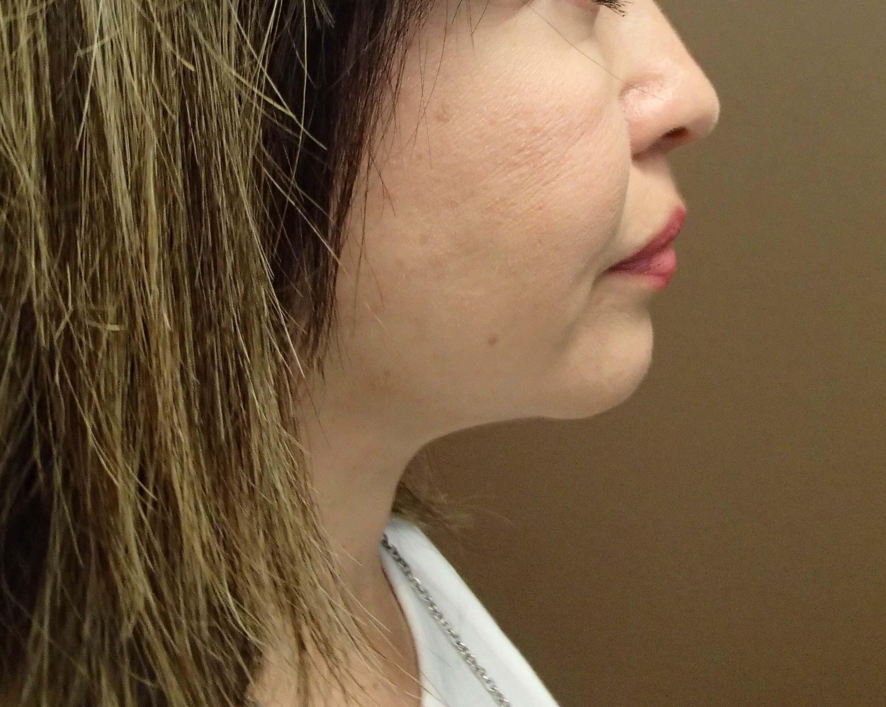 Facelift with Fat Transfer After