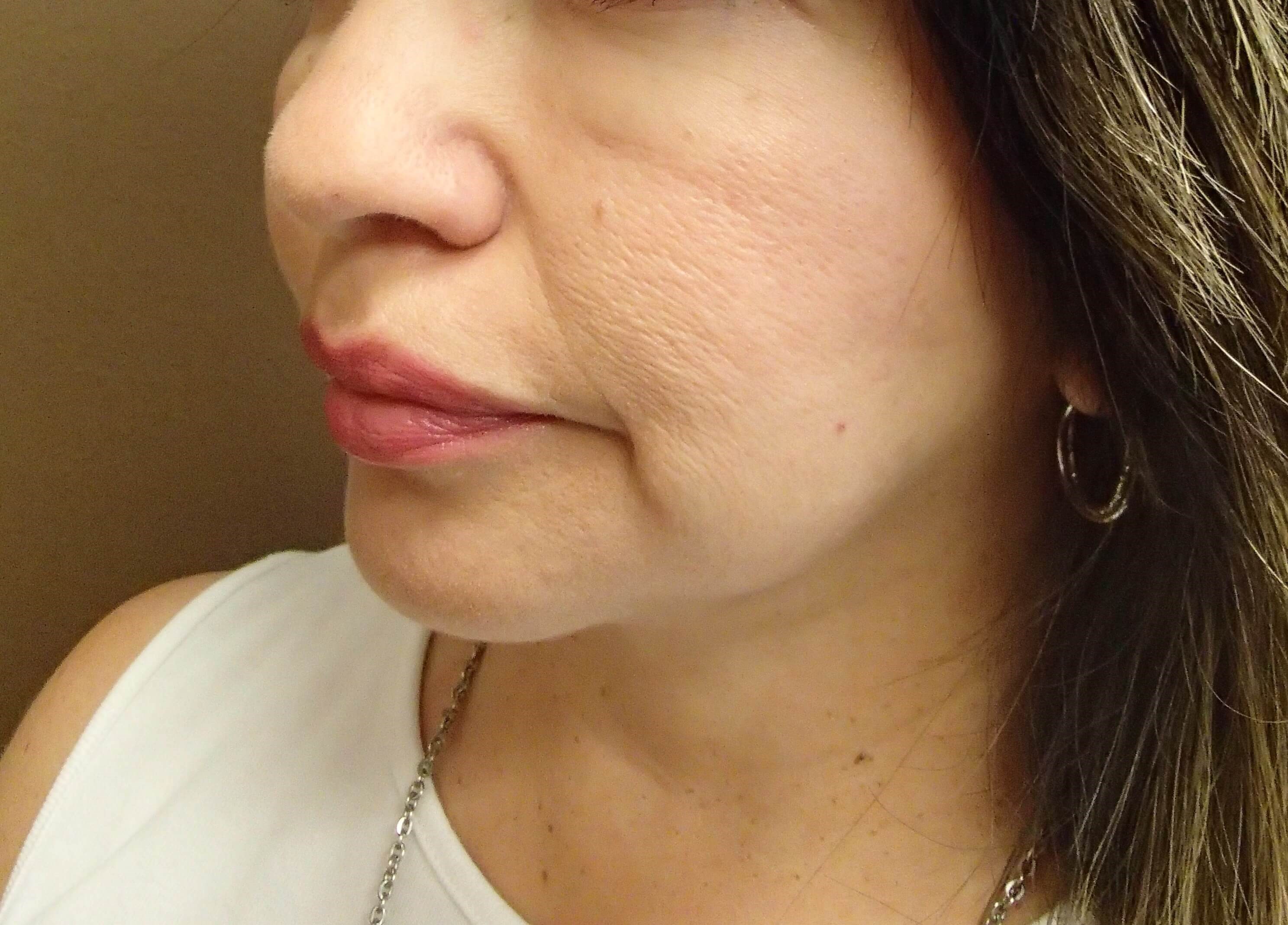Facelift with Fat Transfer After