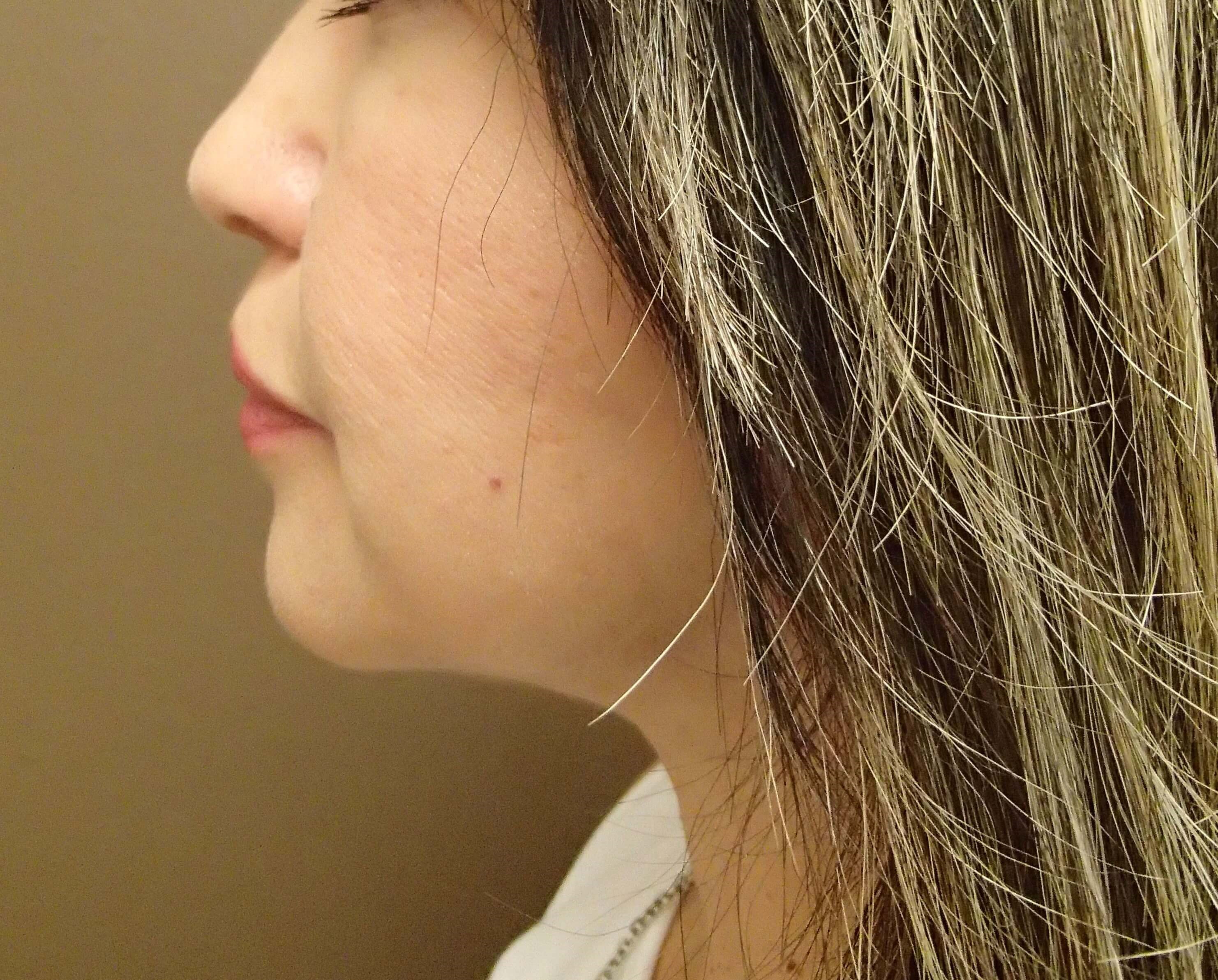 Facelift with Fat Transfer After