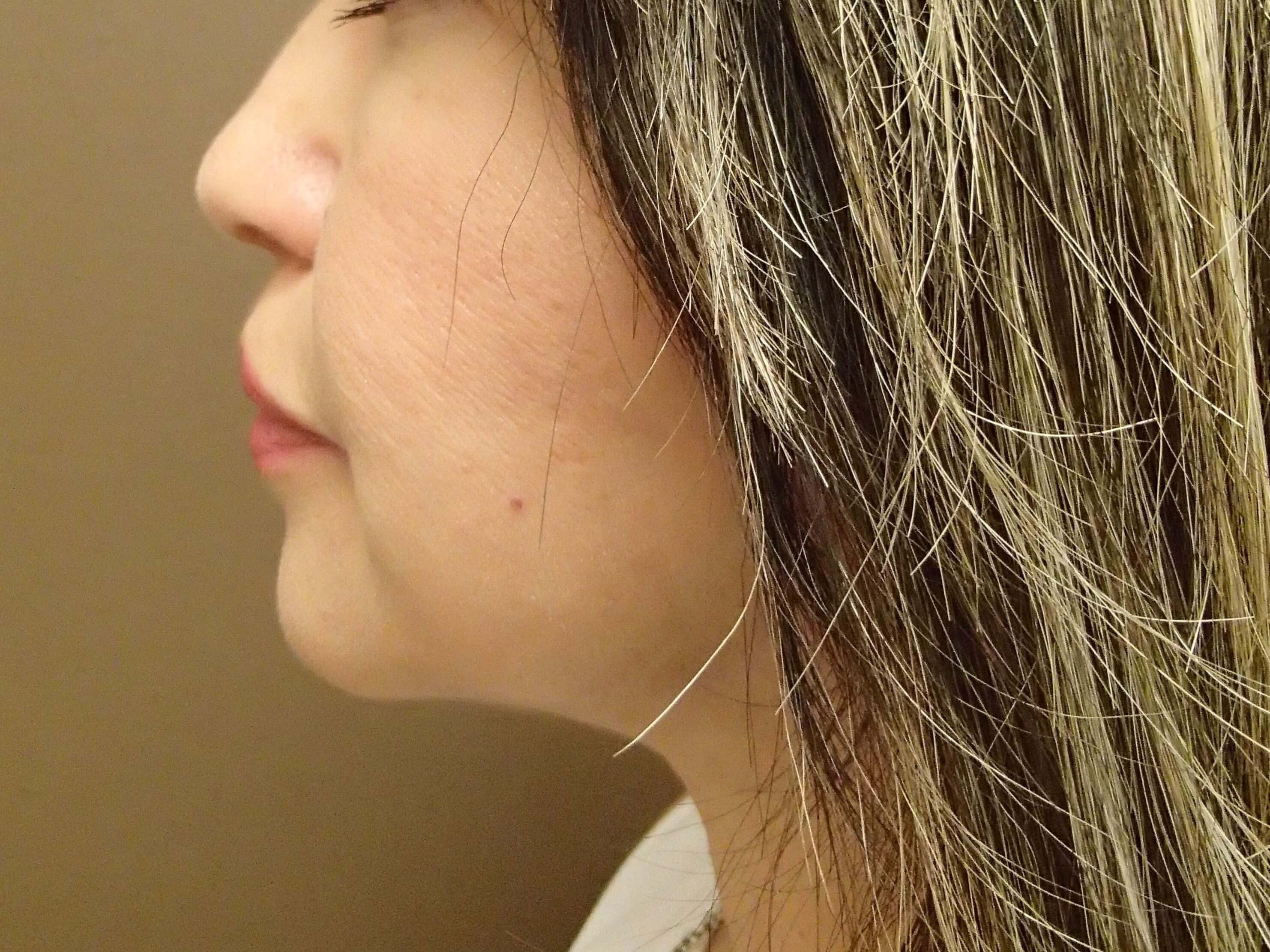 Facelift with Fat Transfer After