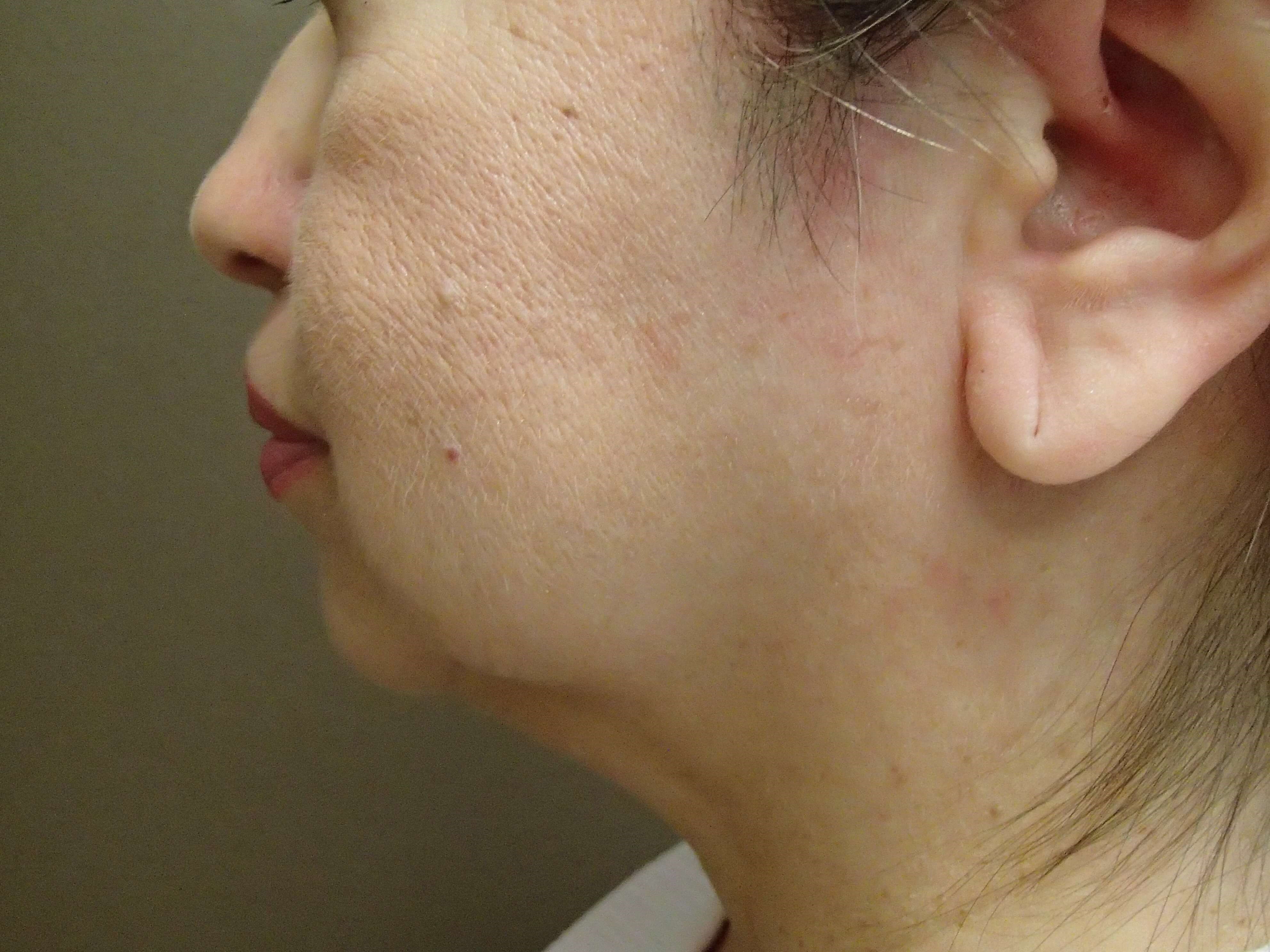 Facelift with Fat Transfer Before