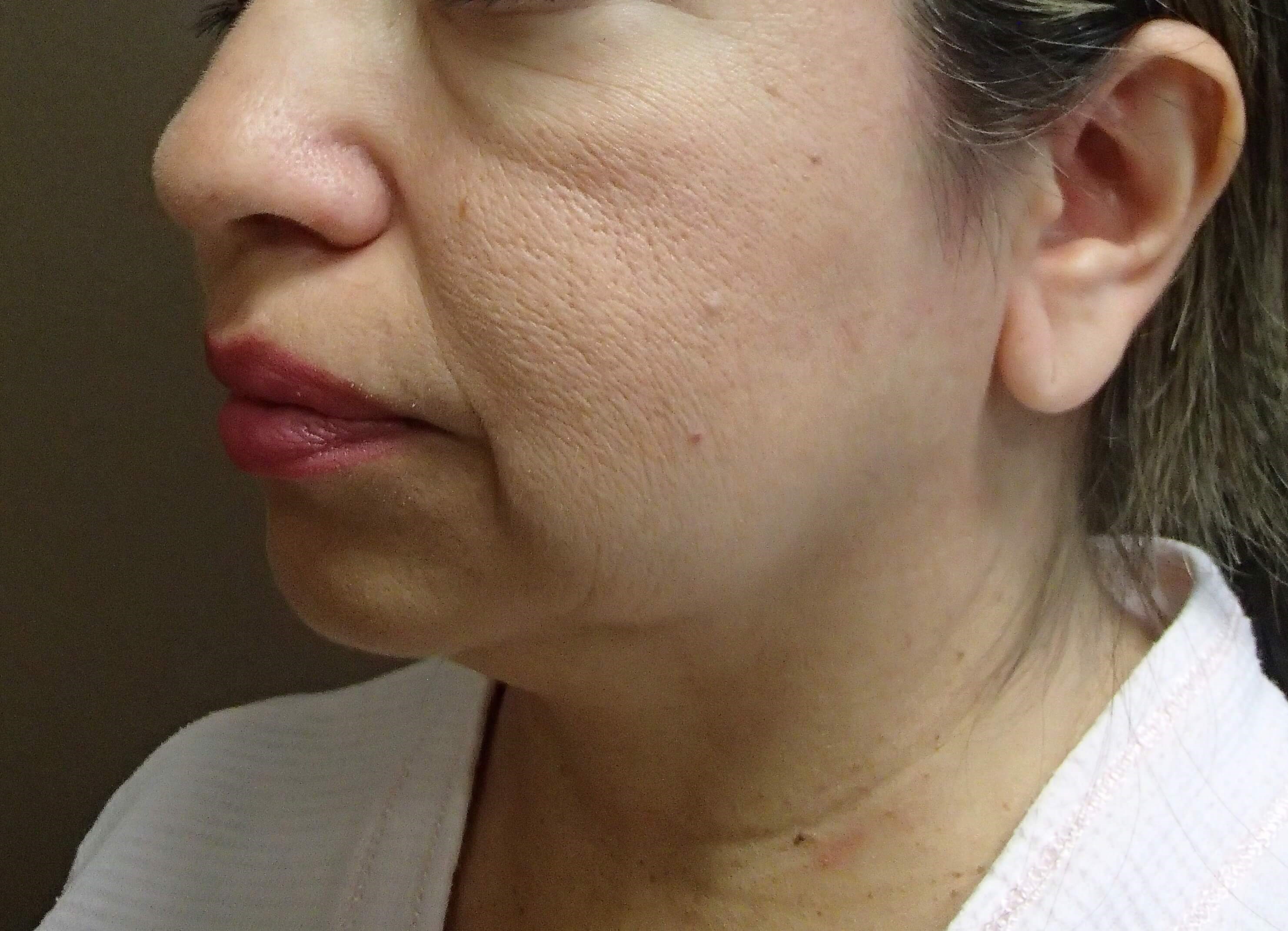 Facelift with Fat Transfer Before
