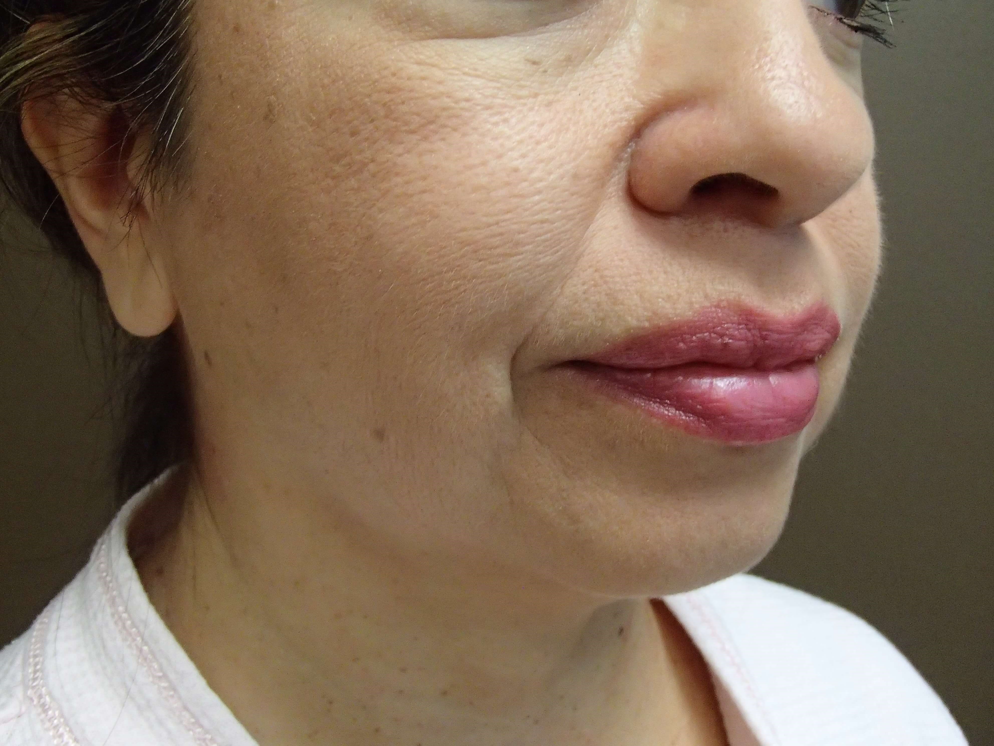 Facelift with Fat Transfer Before