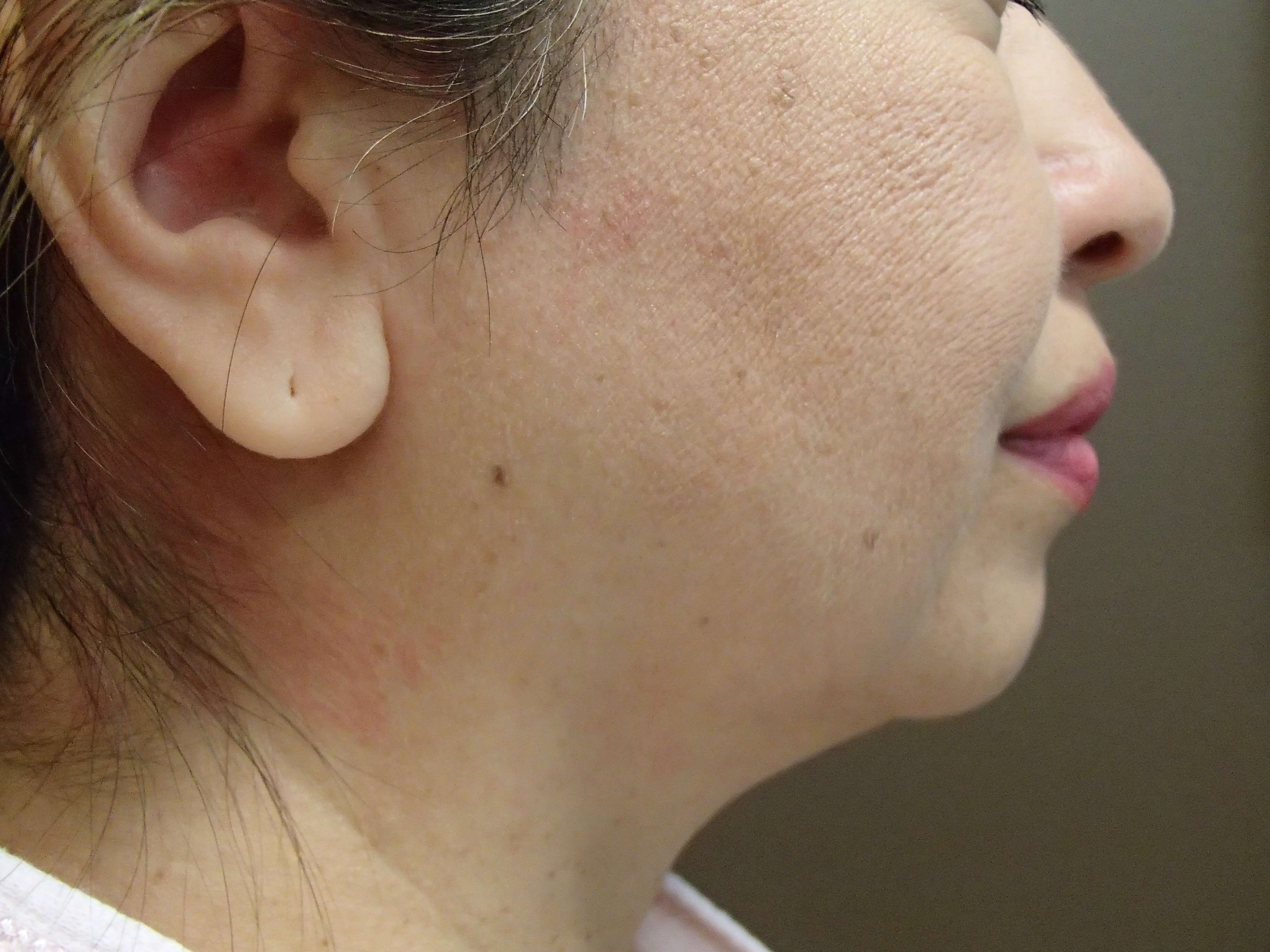 Facelift with Fat Transfer Before