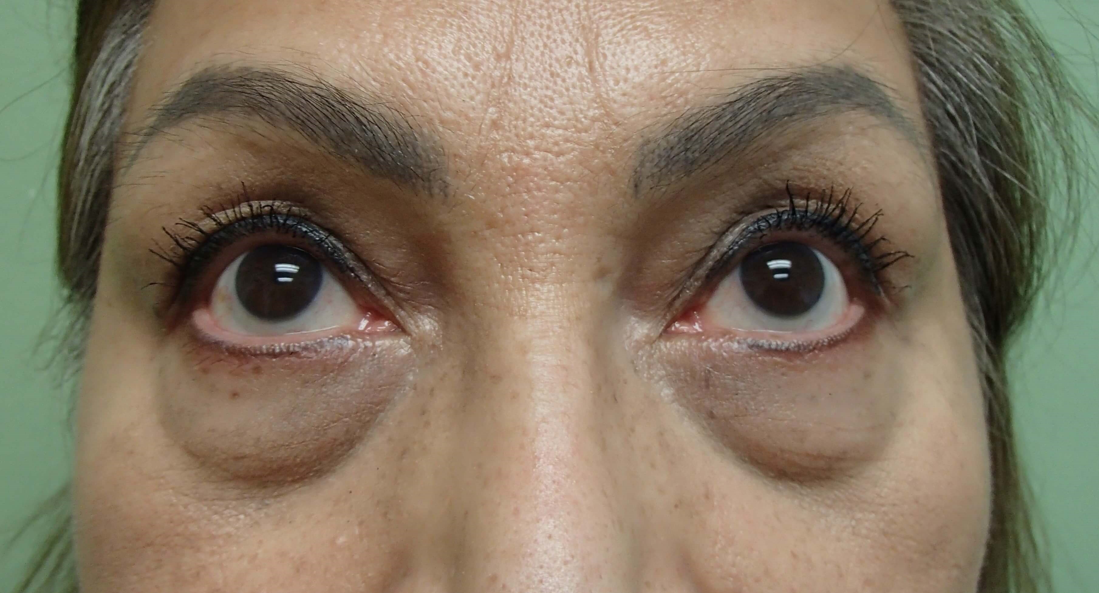 Blepharoplasty Before