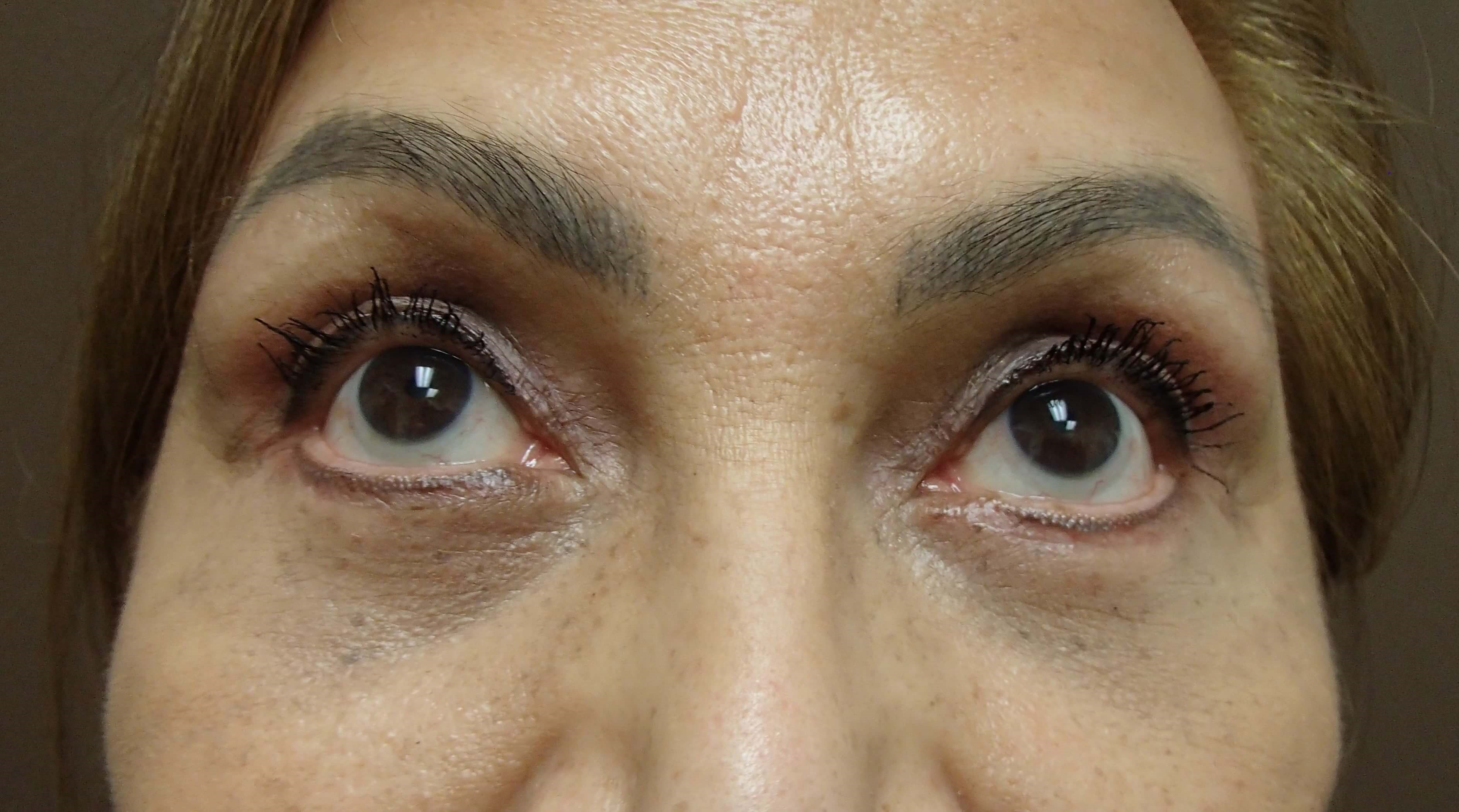 Blepharoplasty After