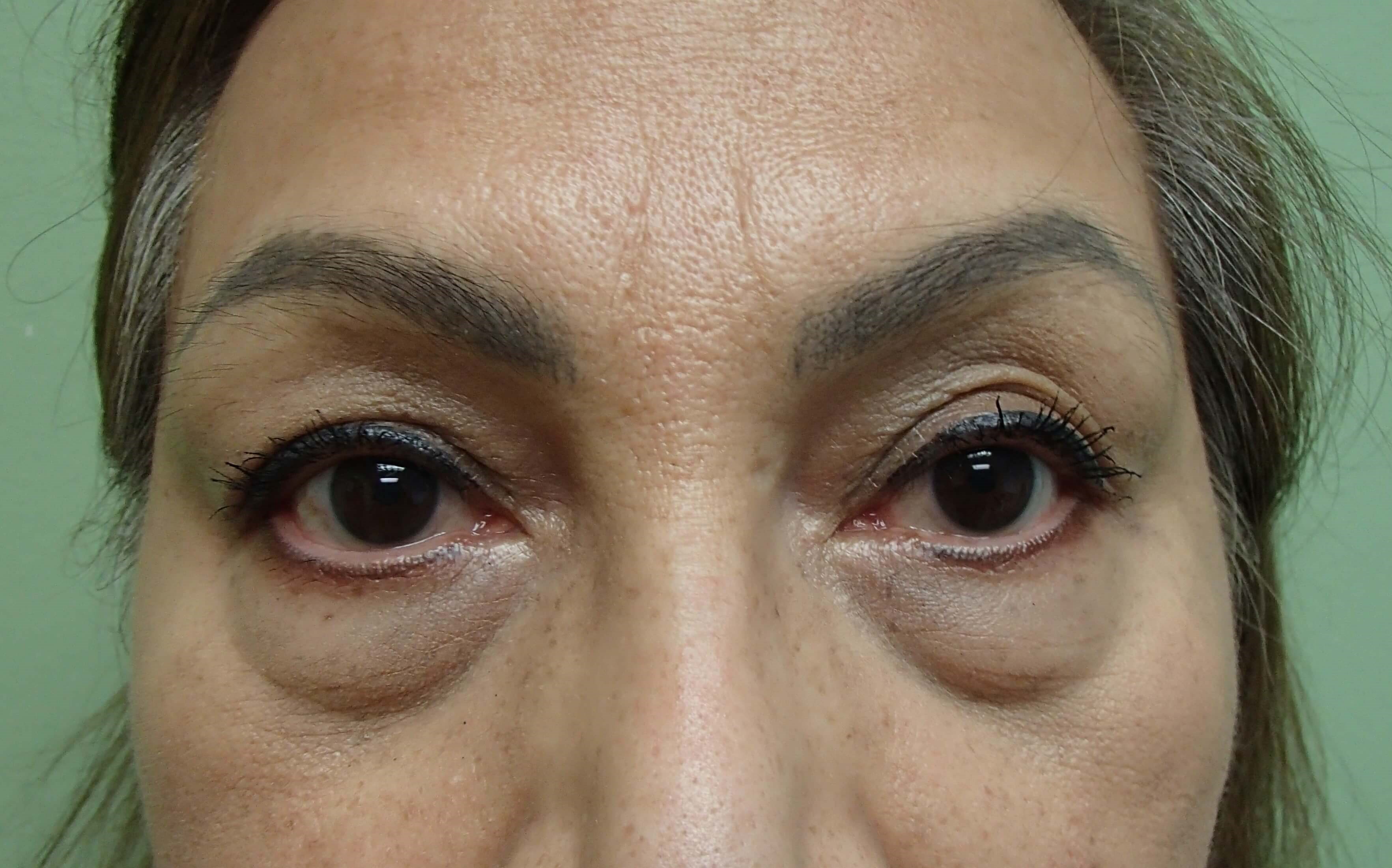Blepharoplasty Before