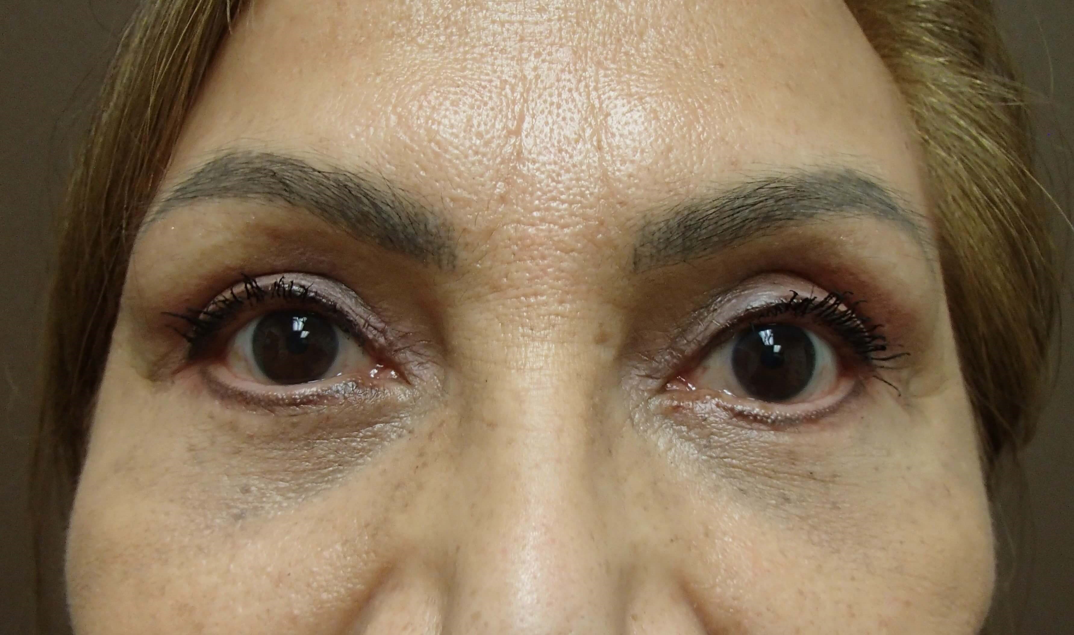Blepharoplasty After