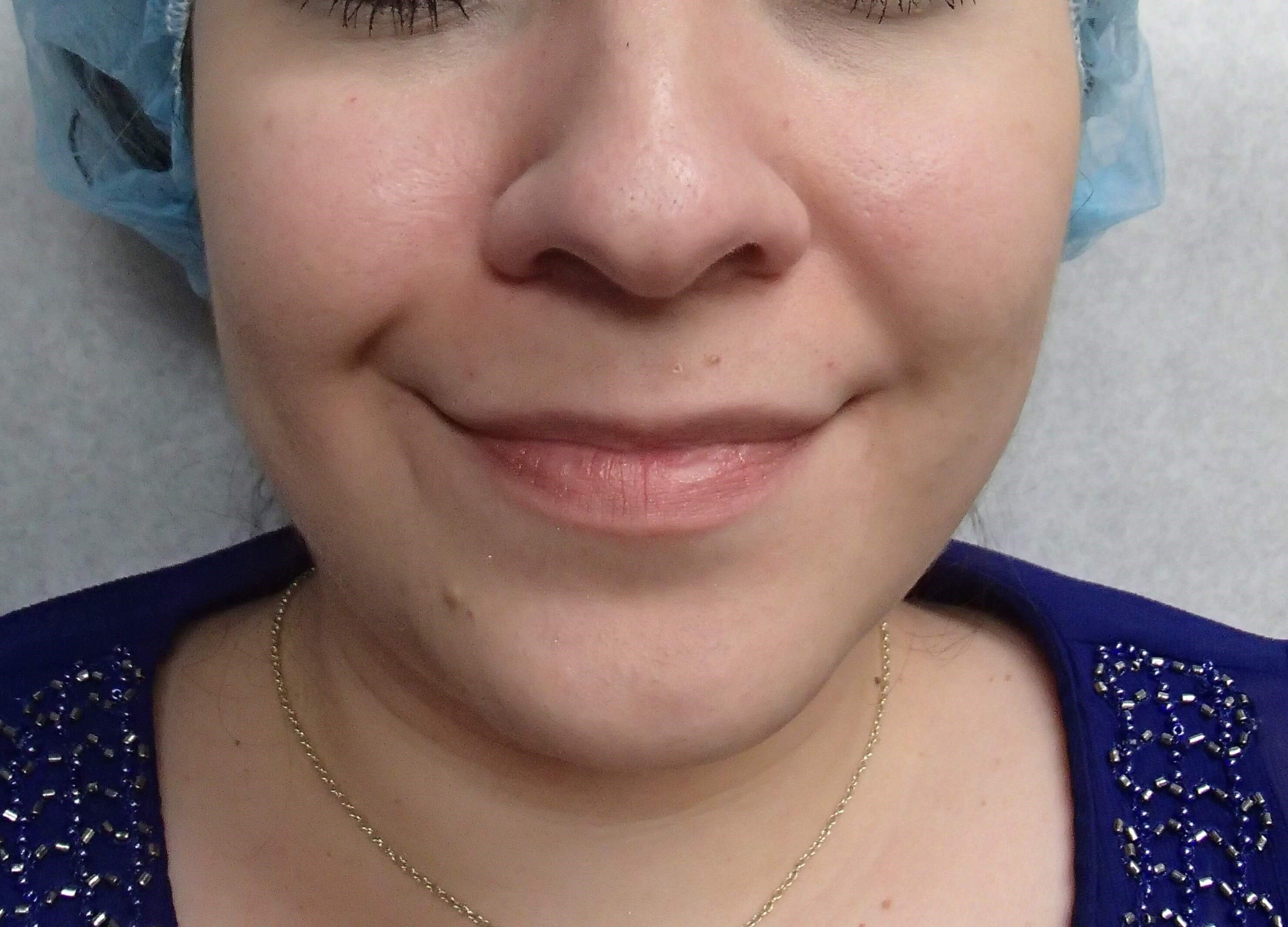 Timeless Dimple Before