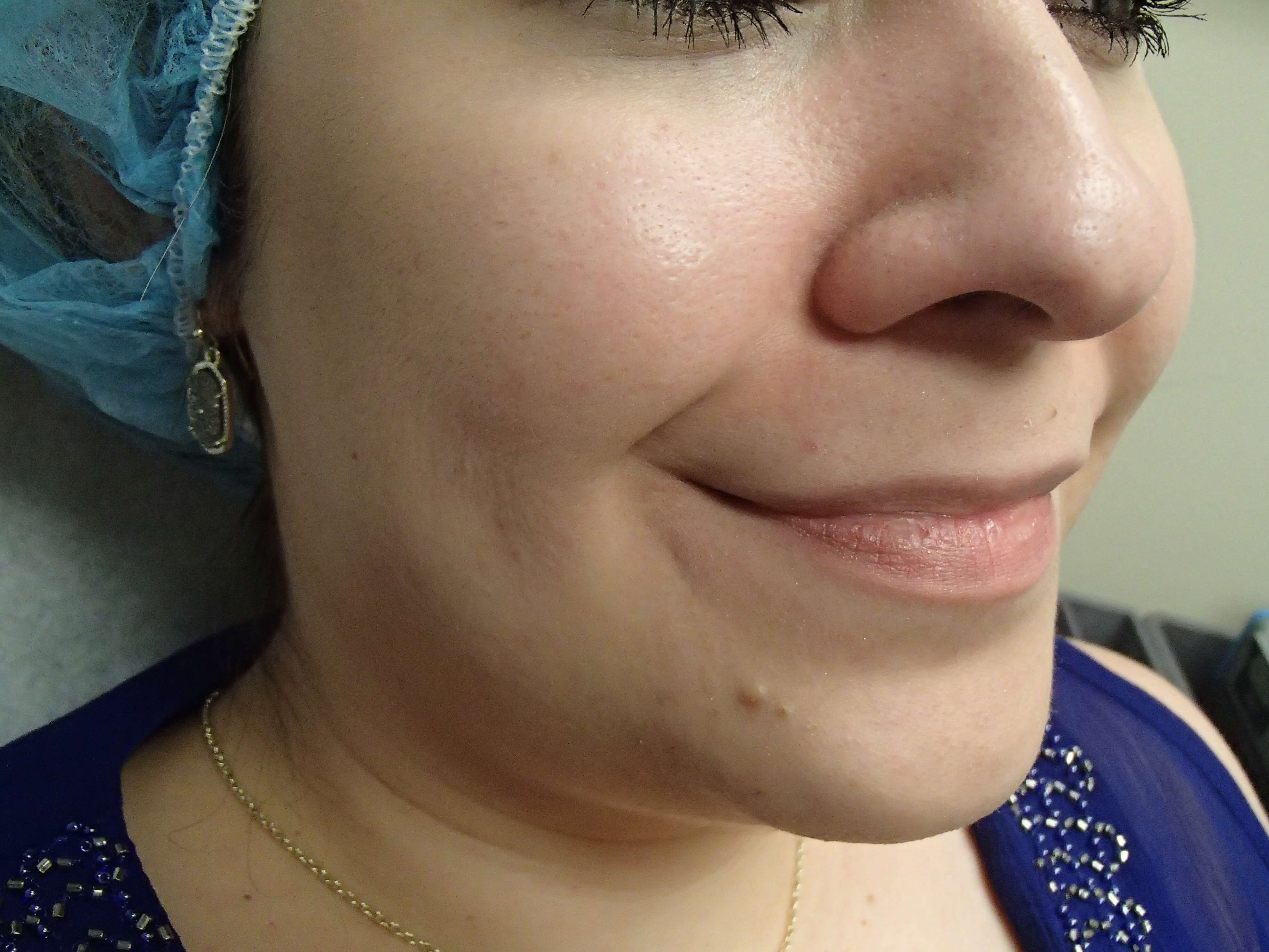 Timeless Dimple Before