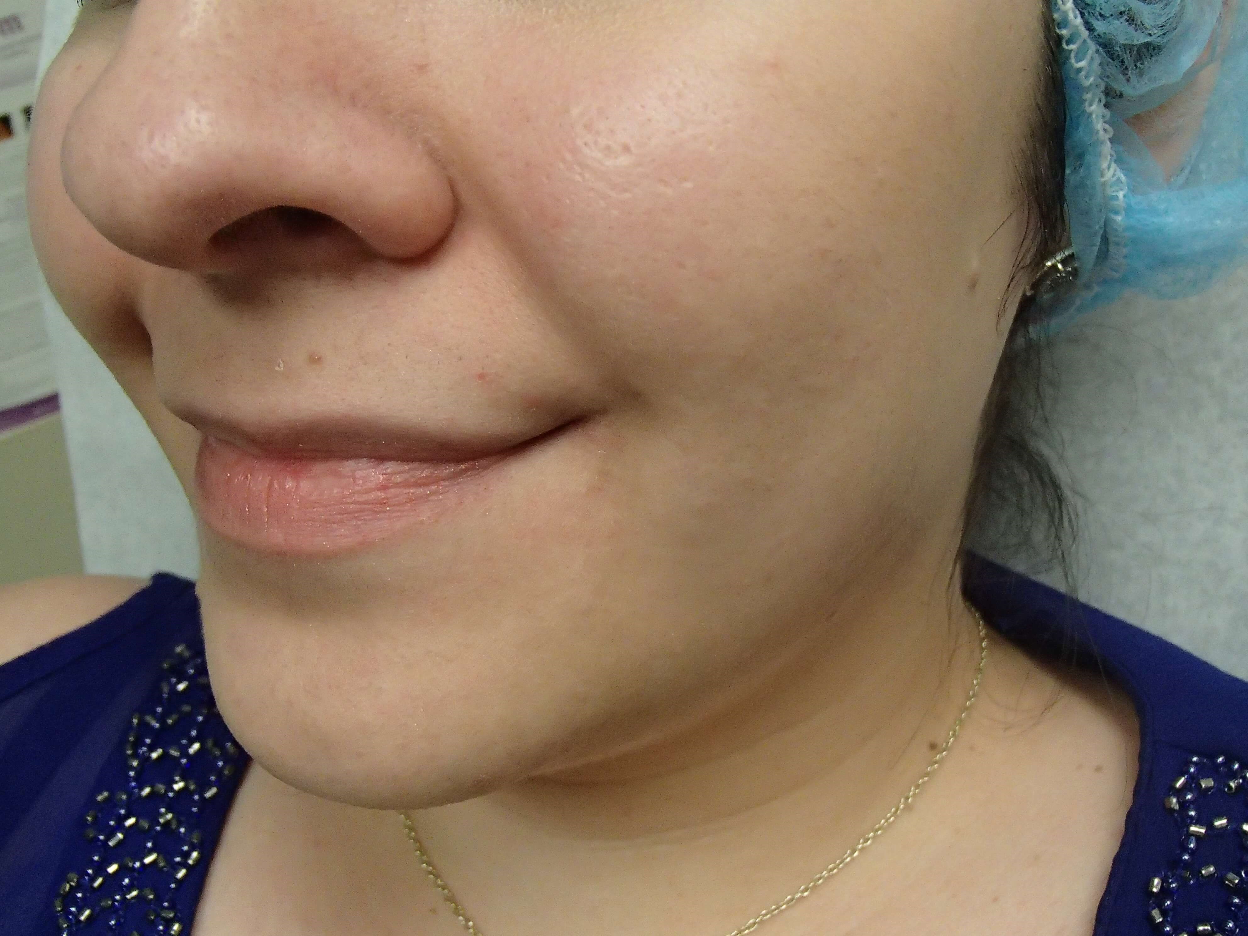 Timeless Dimple Before