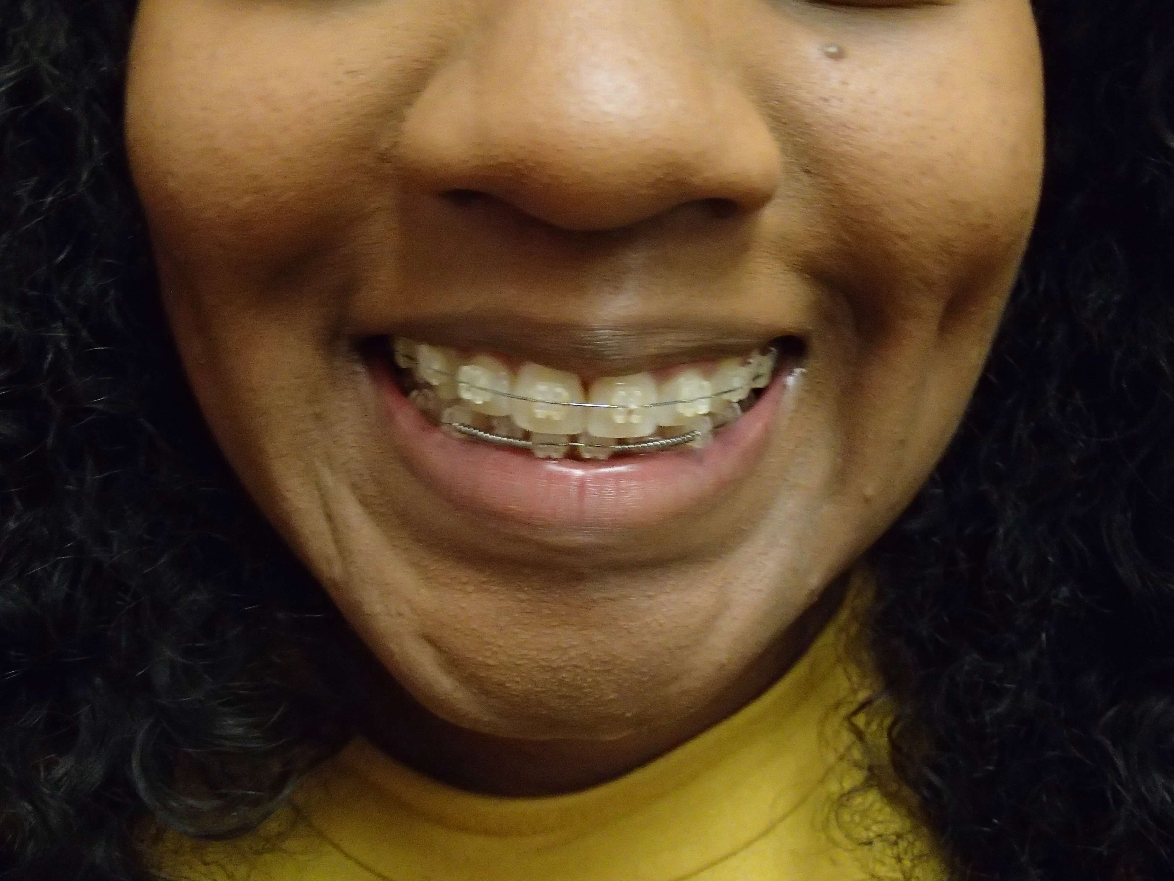 Timeless Dimple After