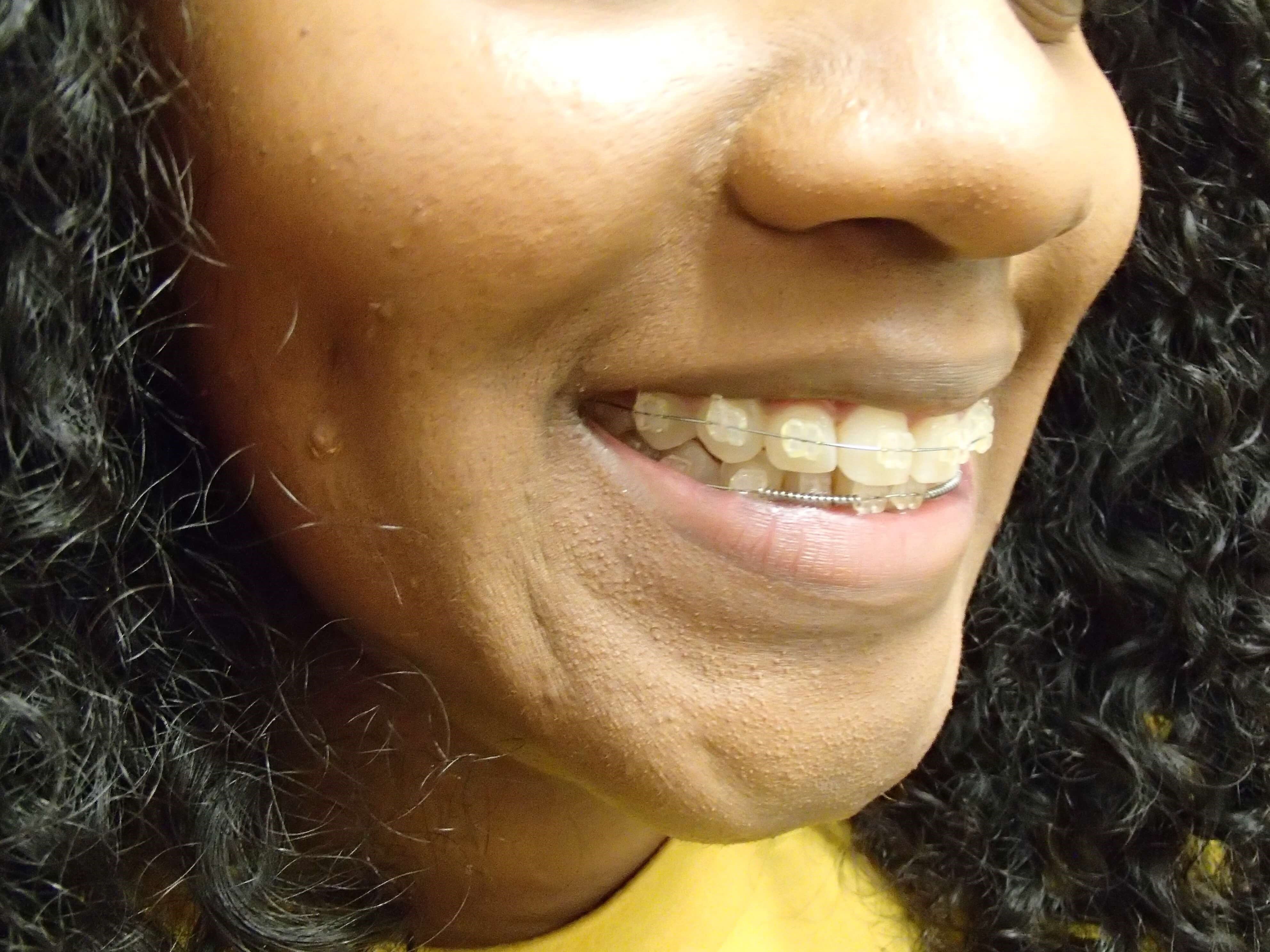 Timeless Dimple After