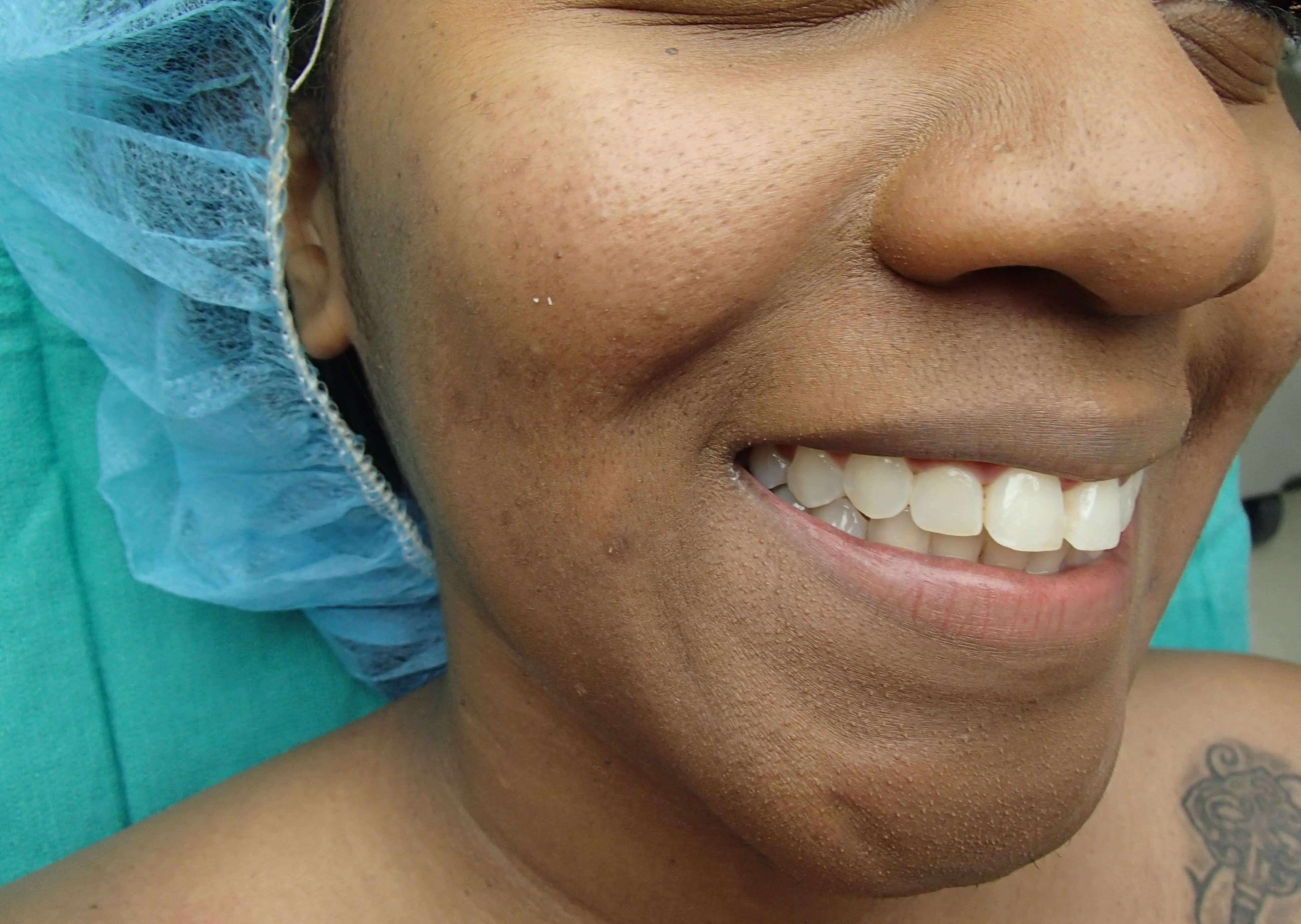 Timeless Dimple Before