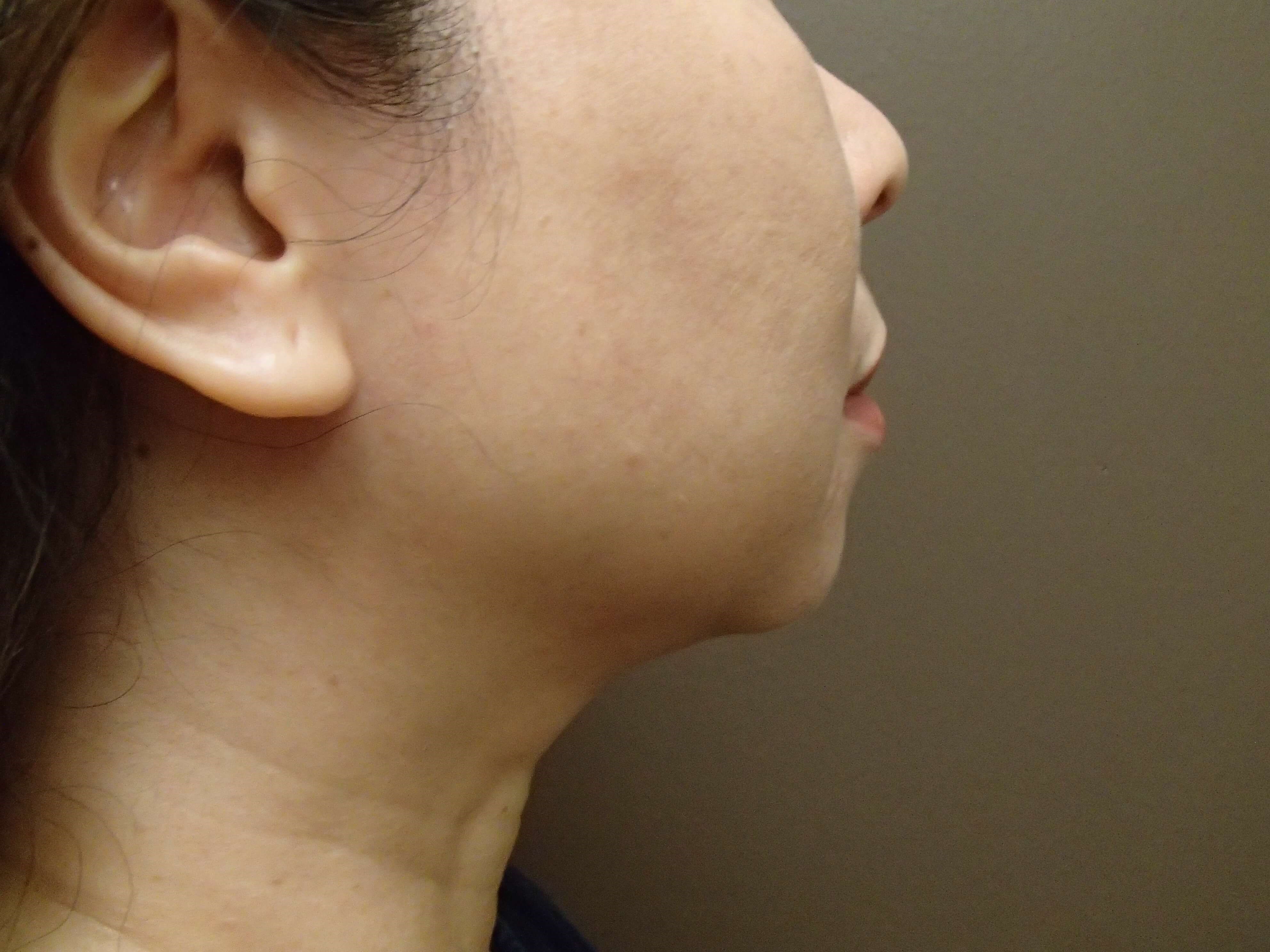 Chin Augmentation Before