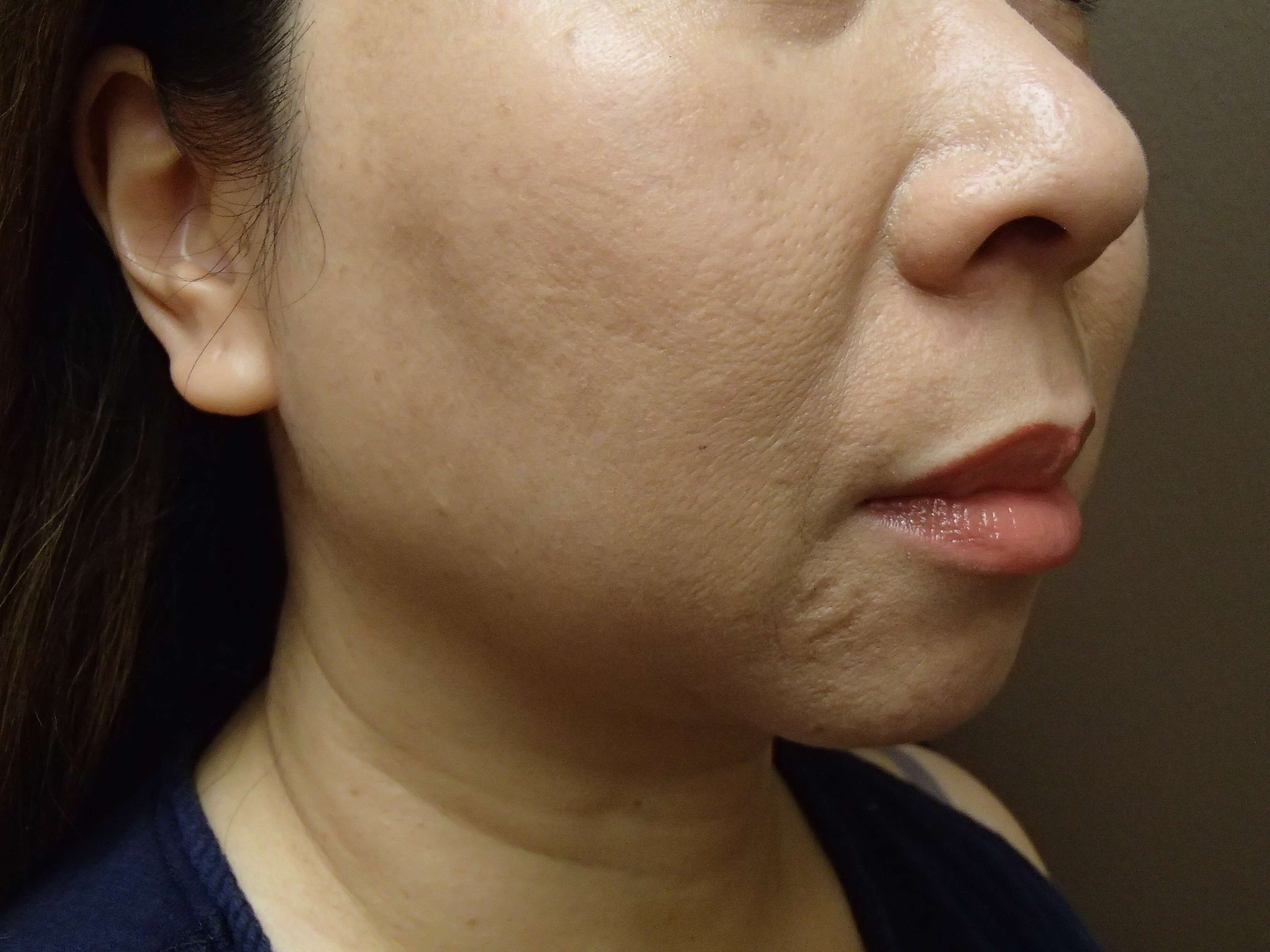 Chin Augmentation Before