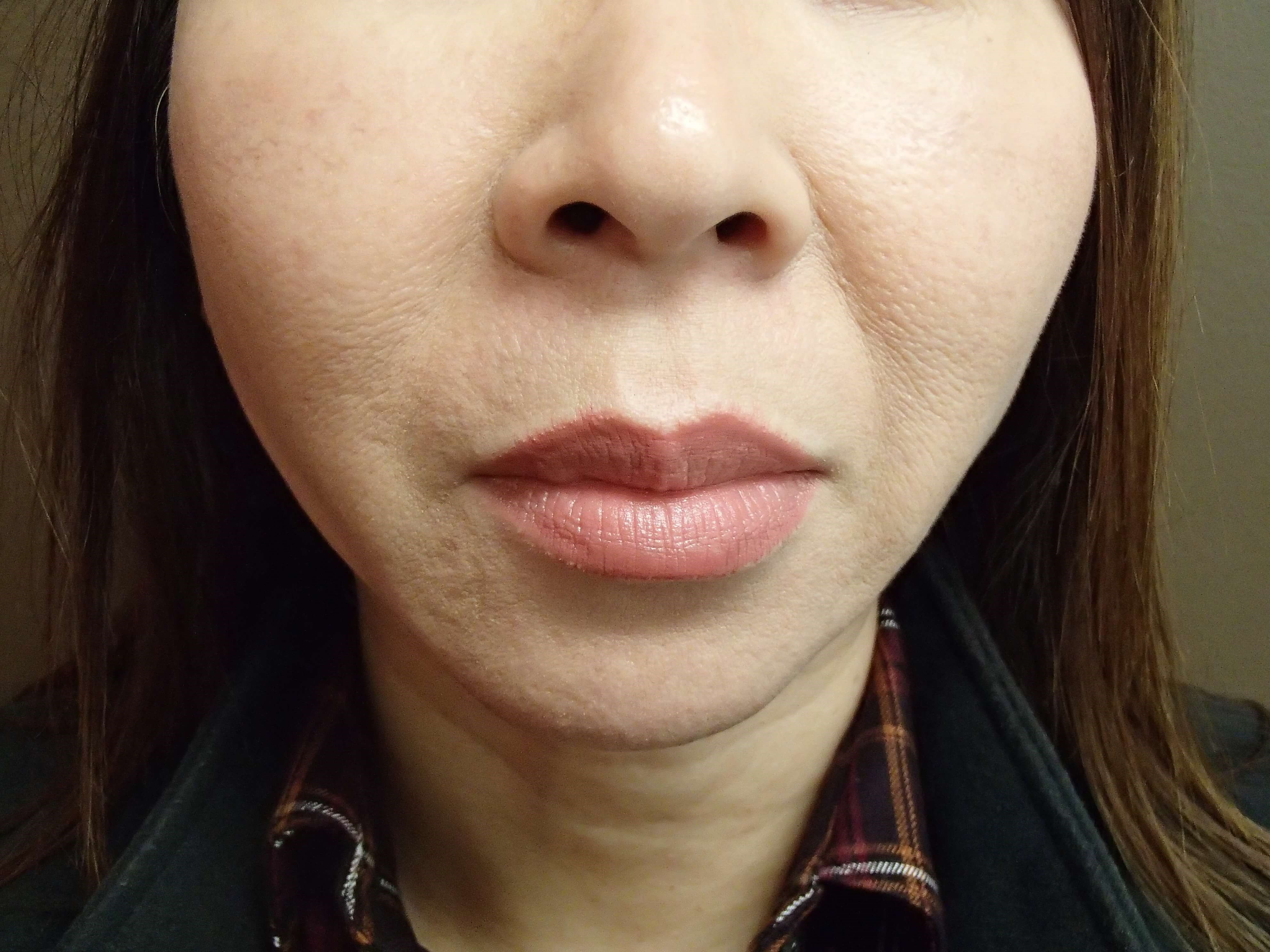 Chin Augmentation After