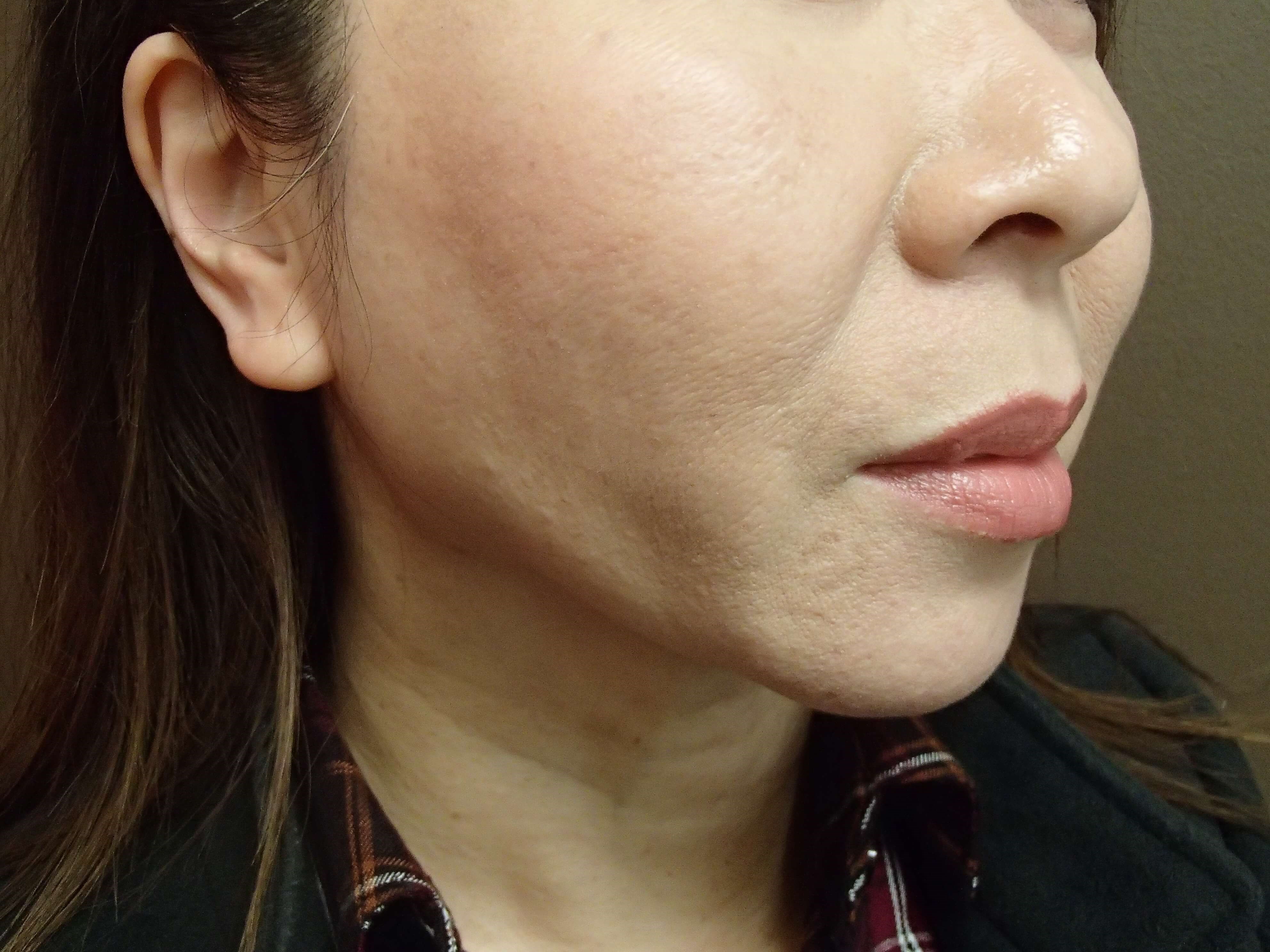 Chin Augmentation After
