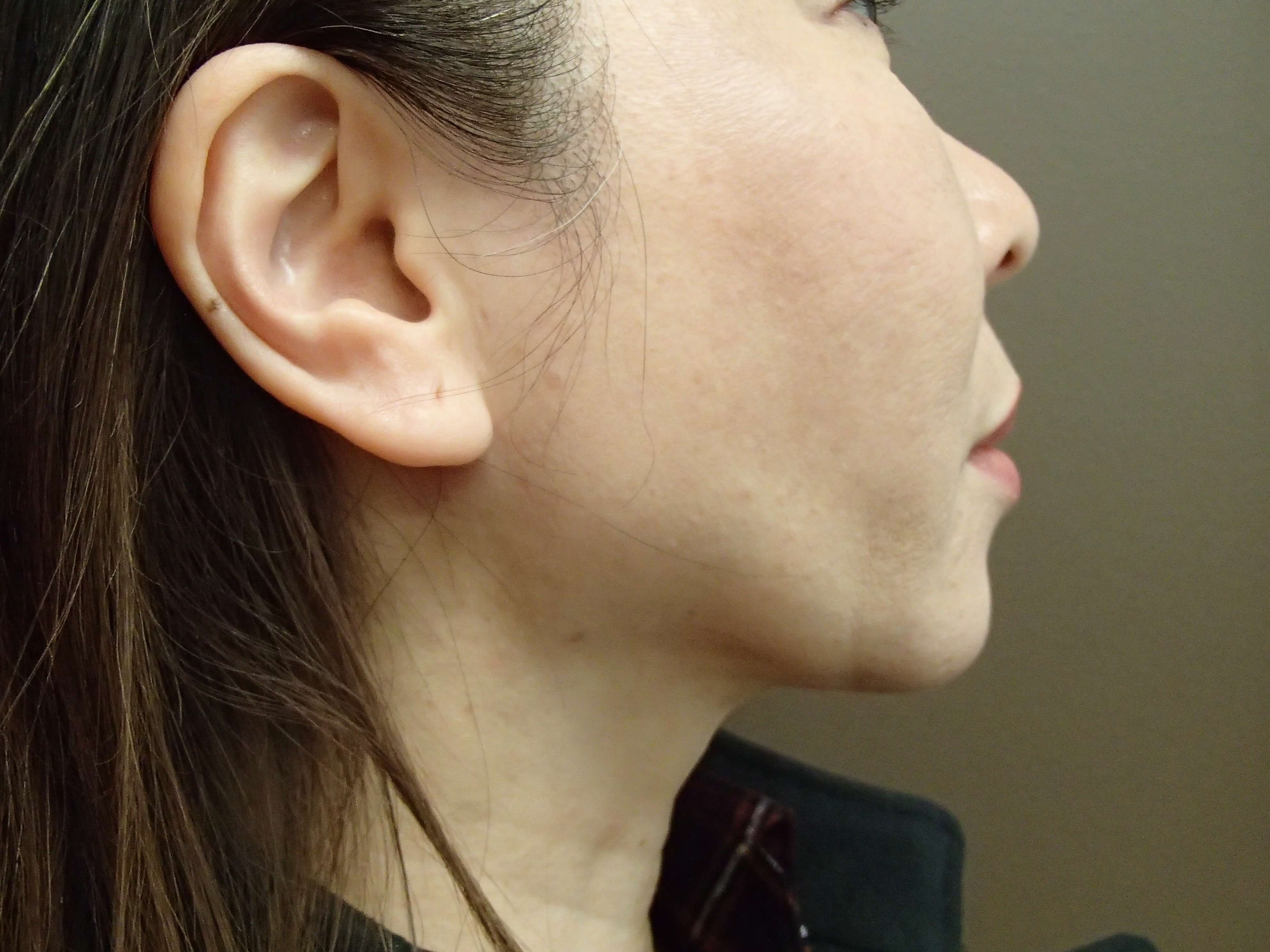 Chin Augmentation After