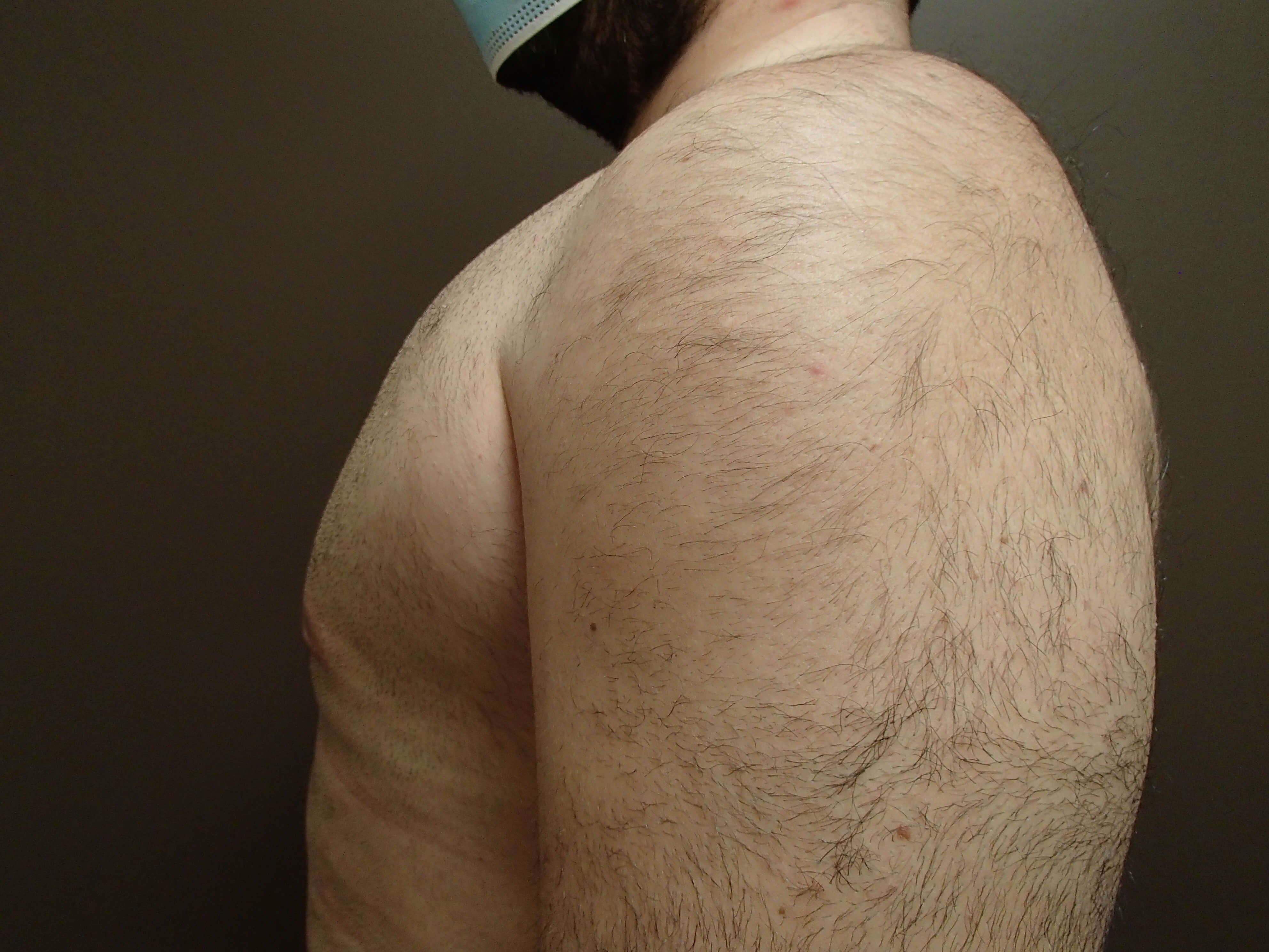 Gynecomastia After