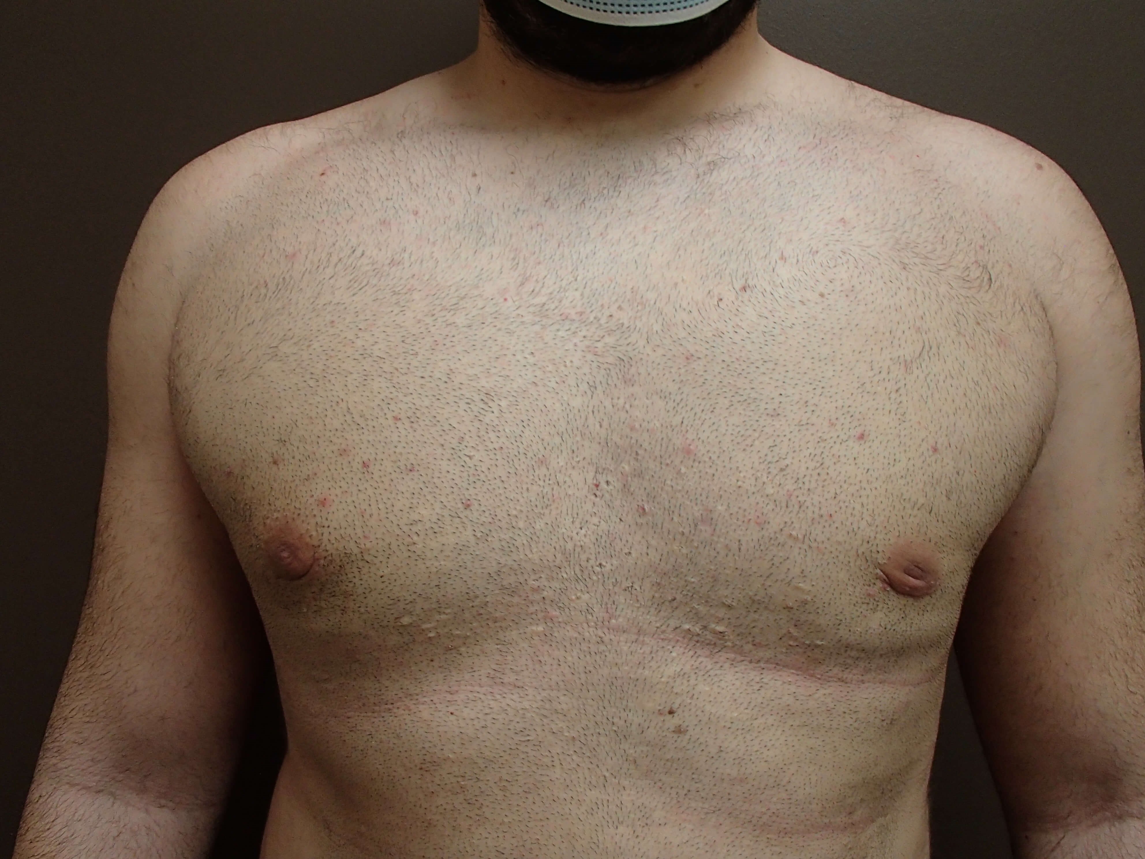 Gynecomastia After