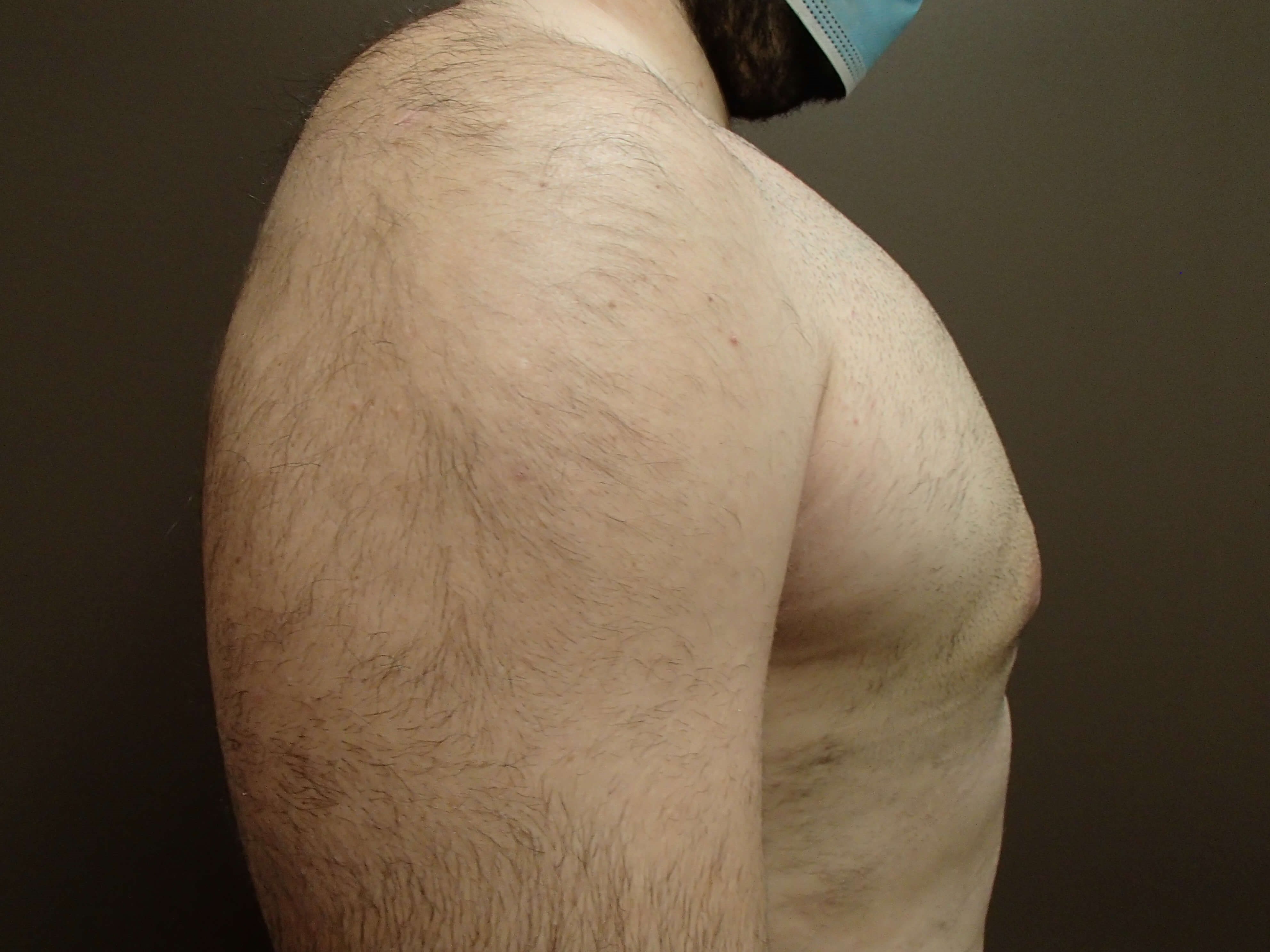 Gynecomastia After