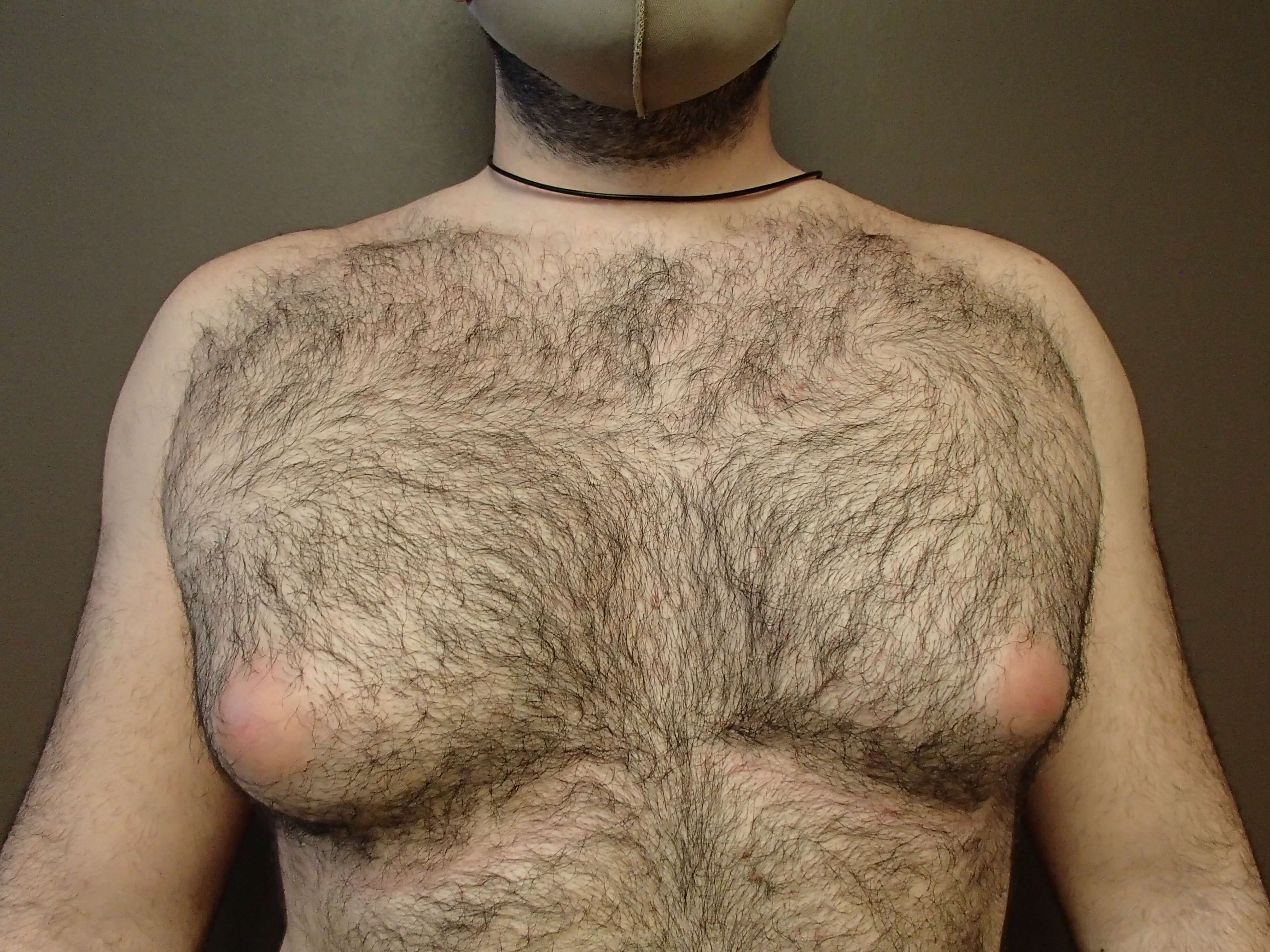 Gynecomastia Before