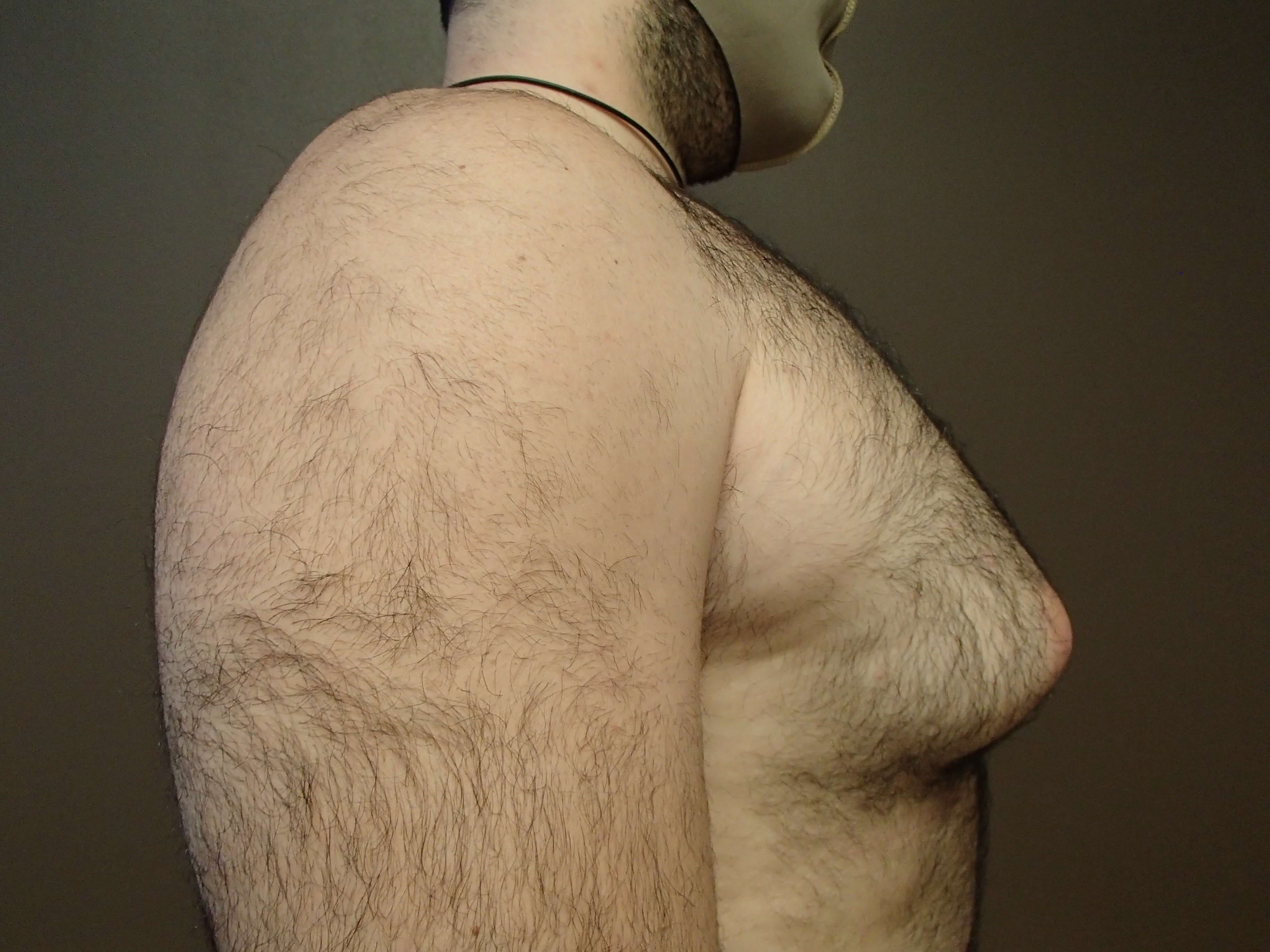 Gynecomastia Before