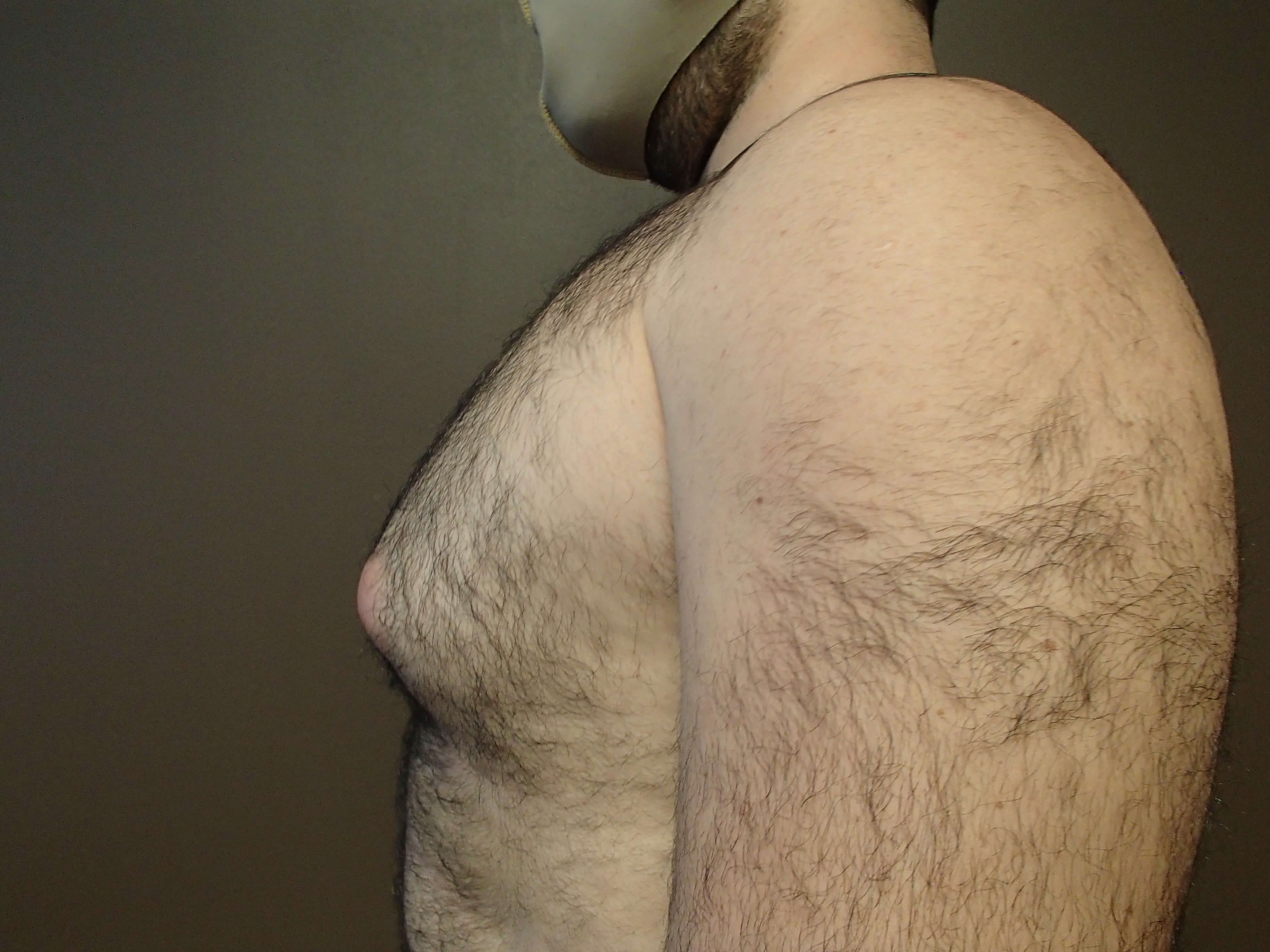 Gynecomastia Before