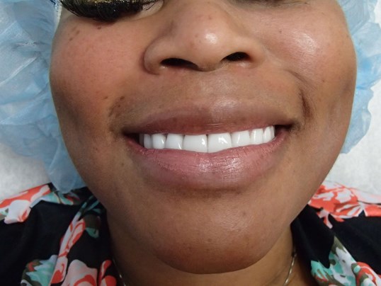 Timeless Dimple Before