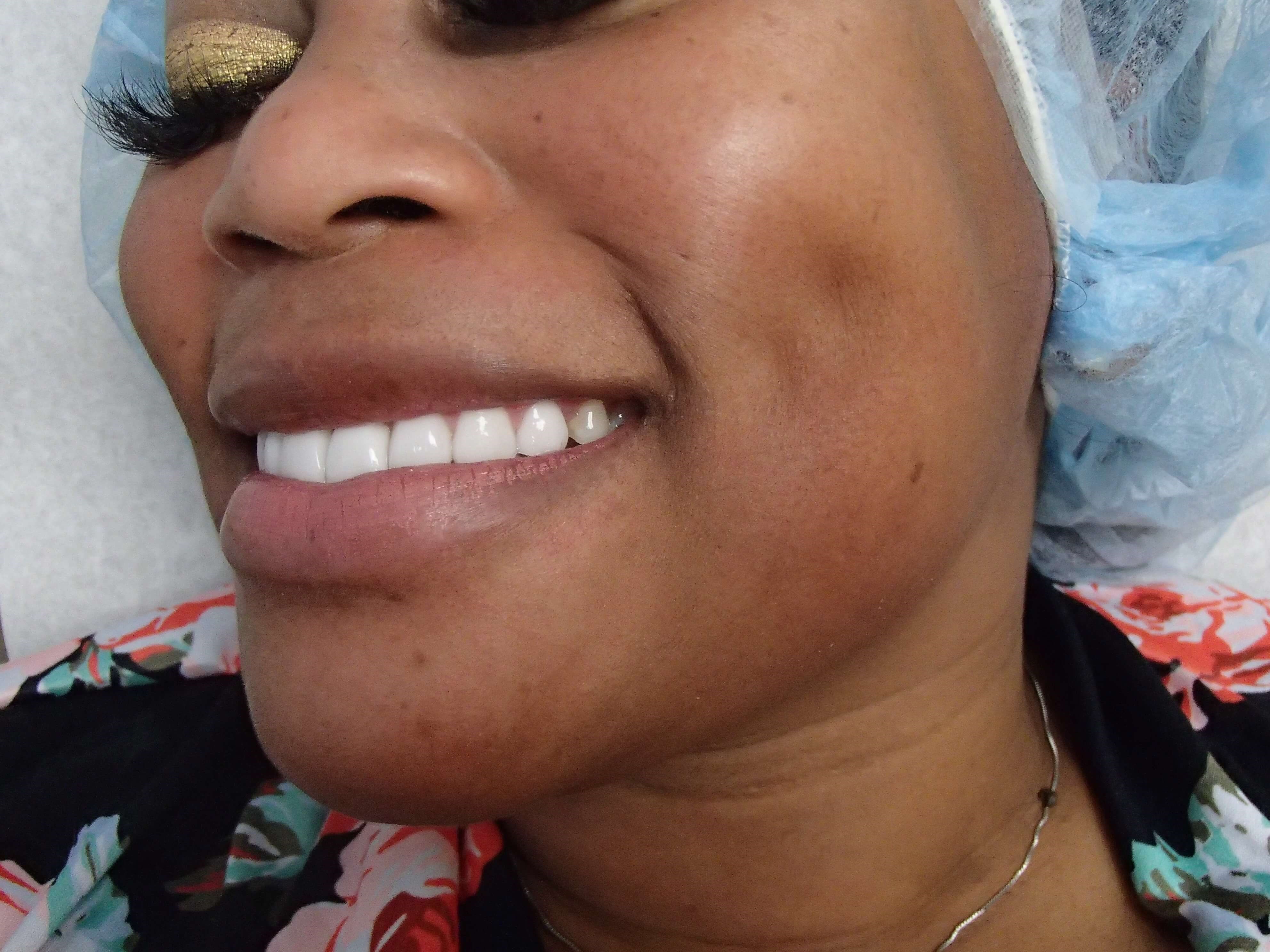 Timeless Dimple Before