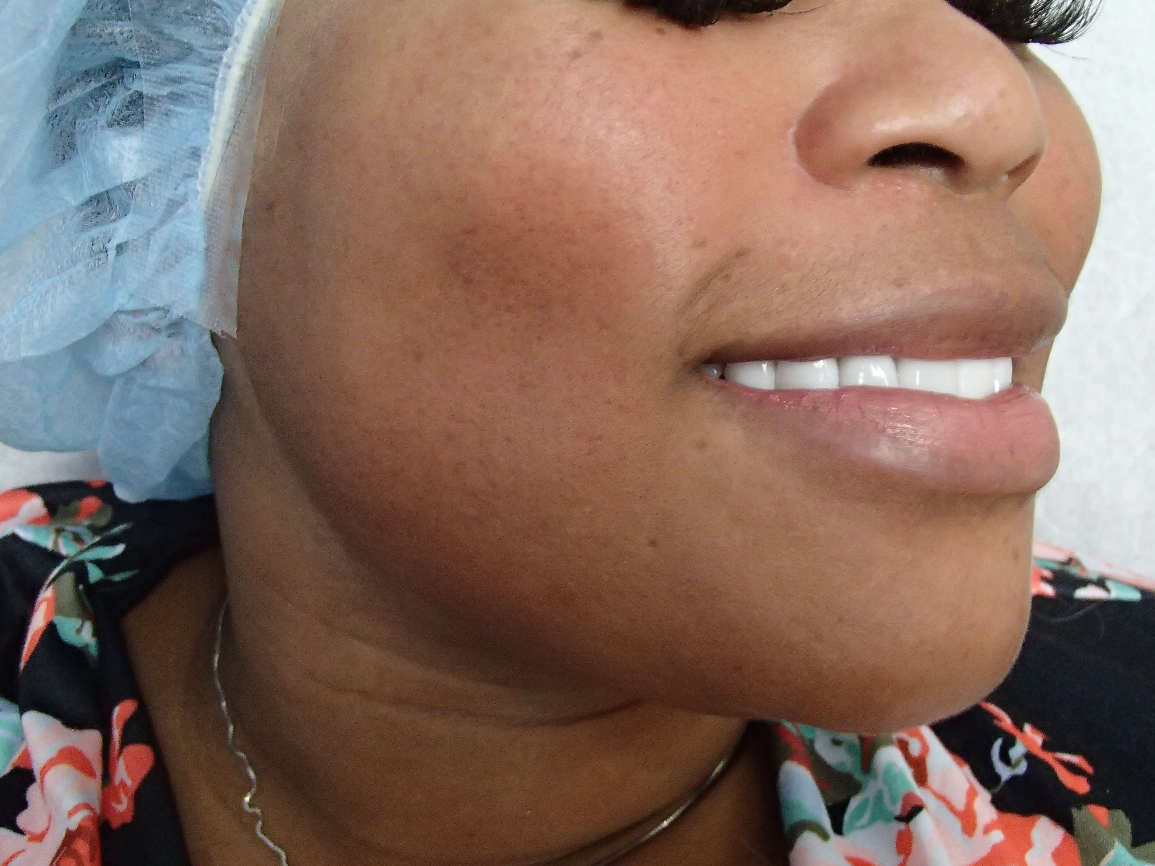 Timeless Dimple Before