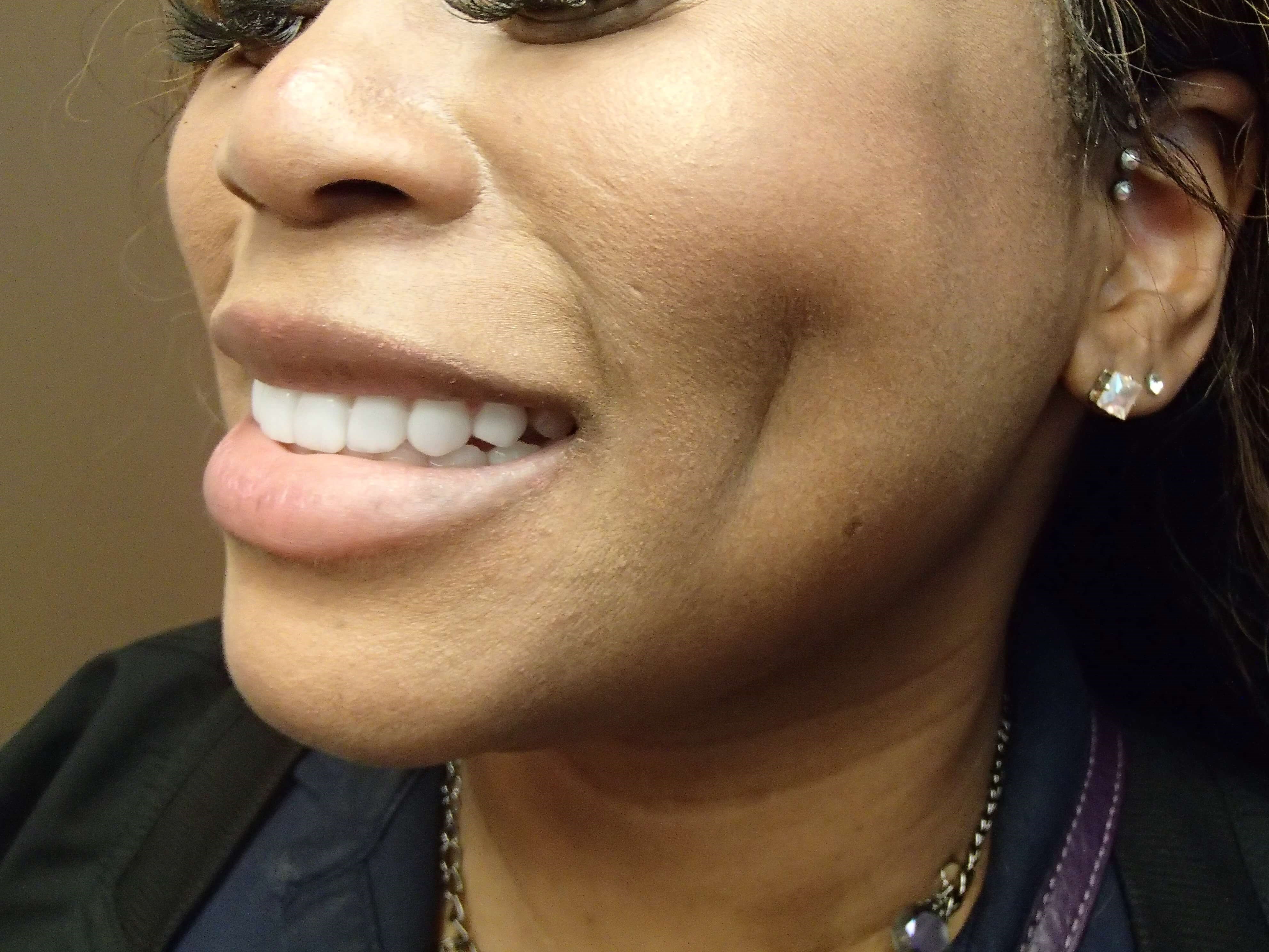 Timeless Dimple After