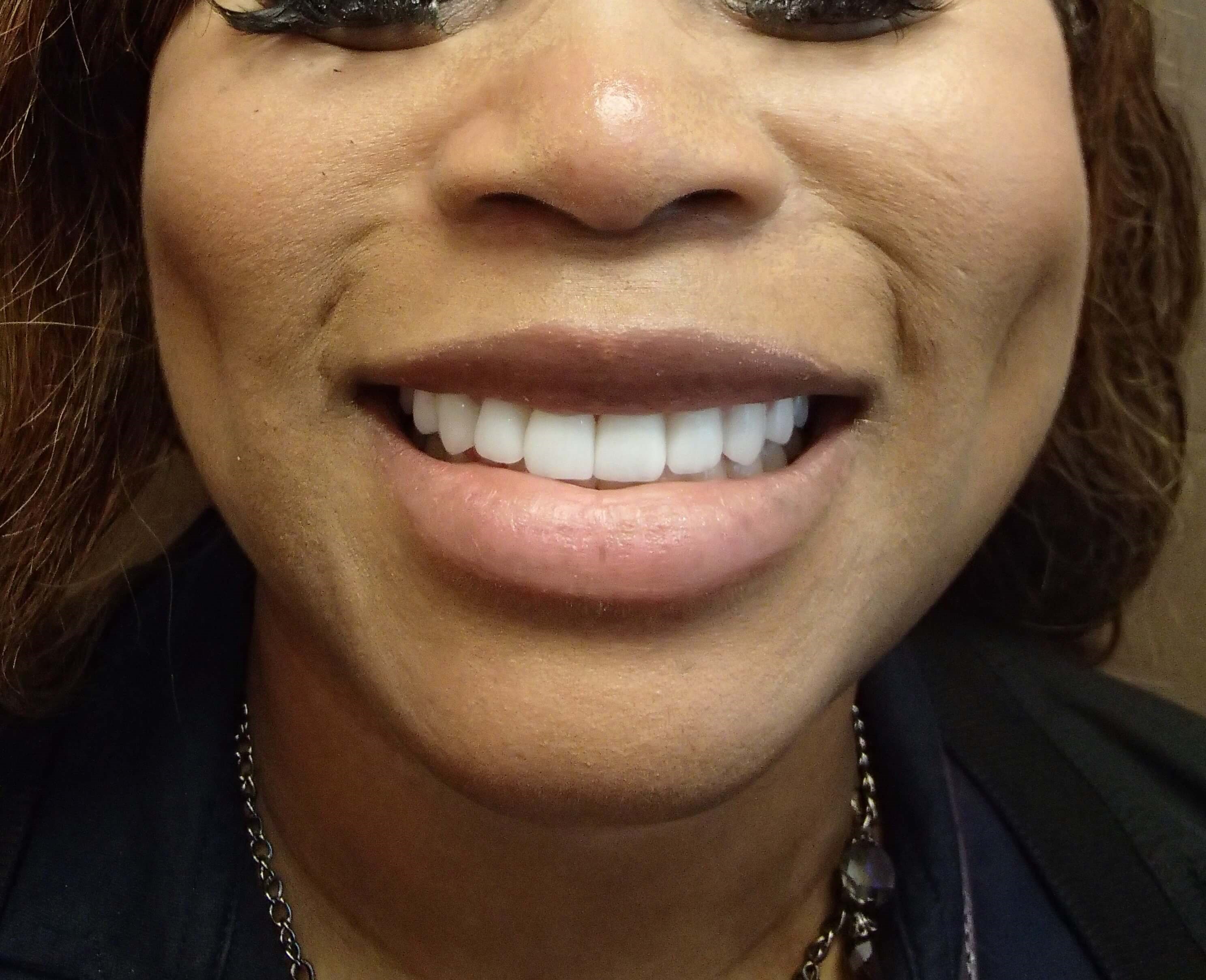 Timeless Dimple After