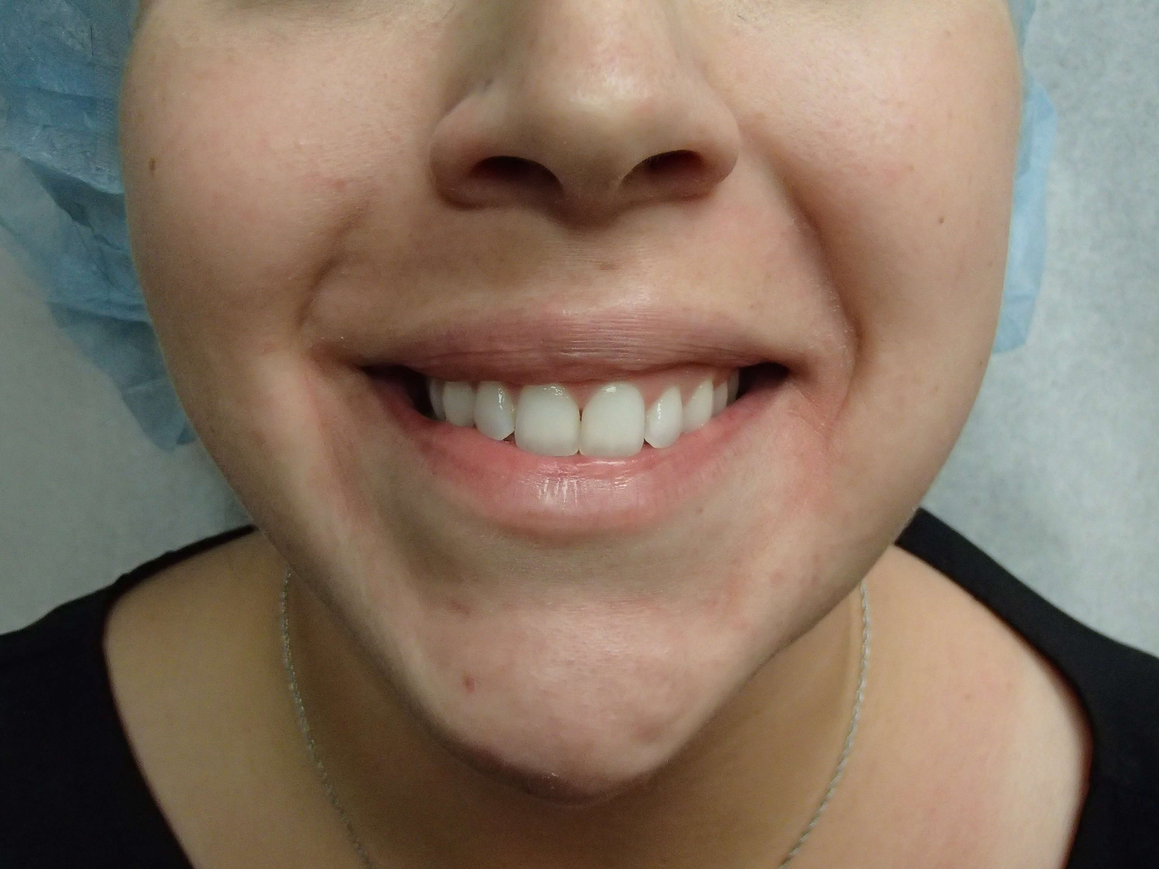 Timeless Dimple Before