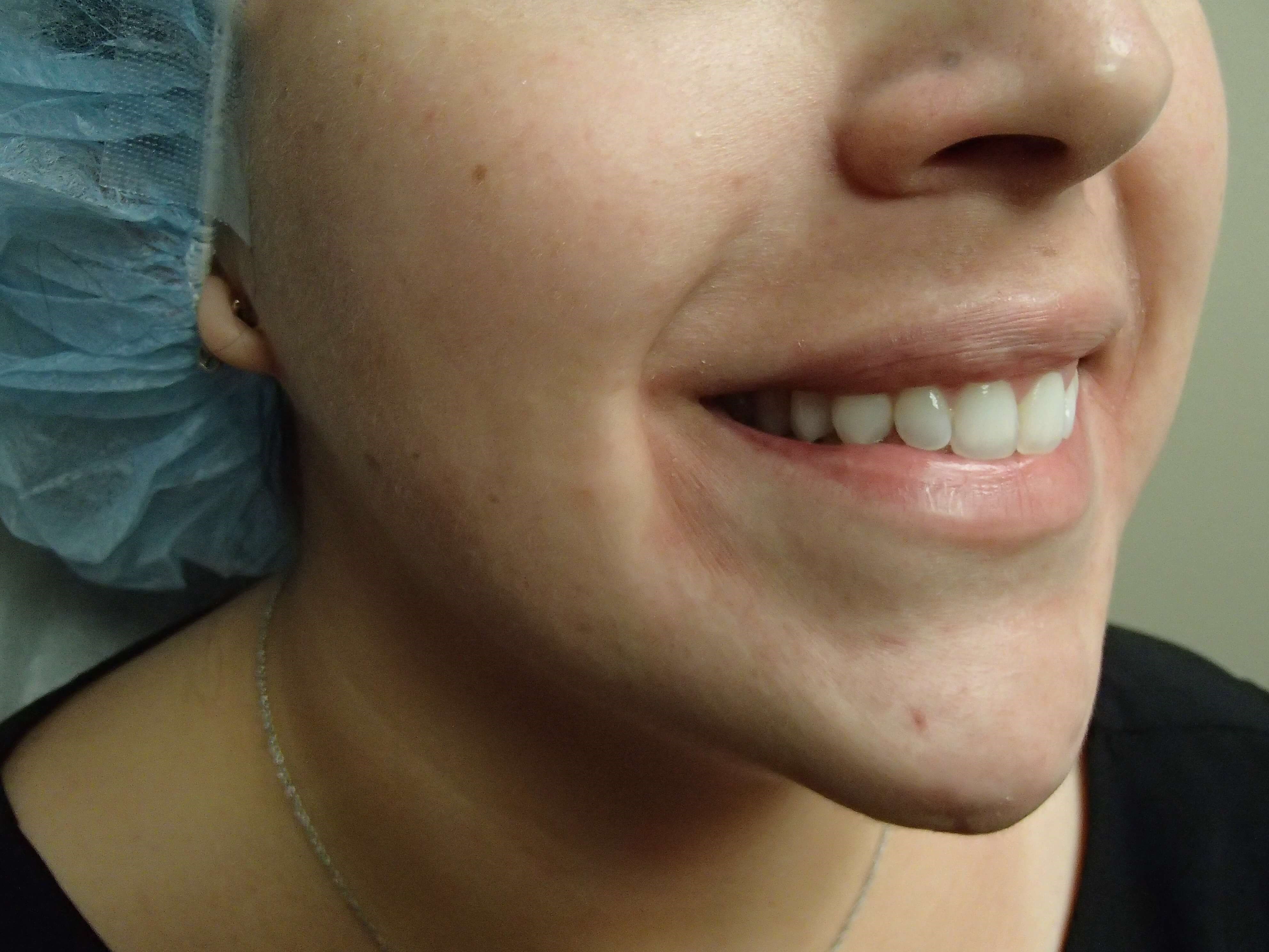 Timeless Dimple Before