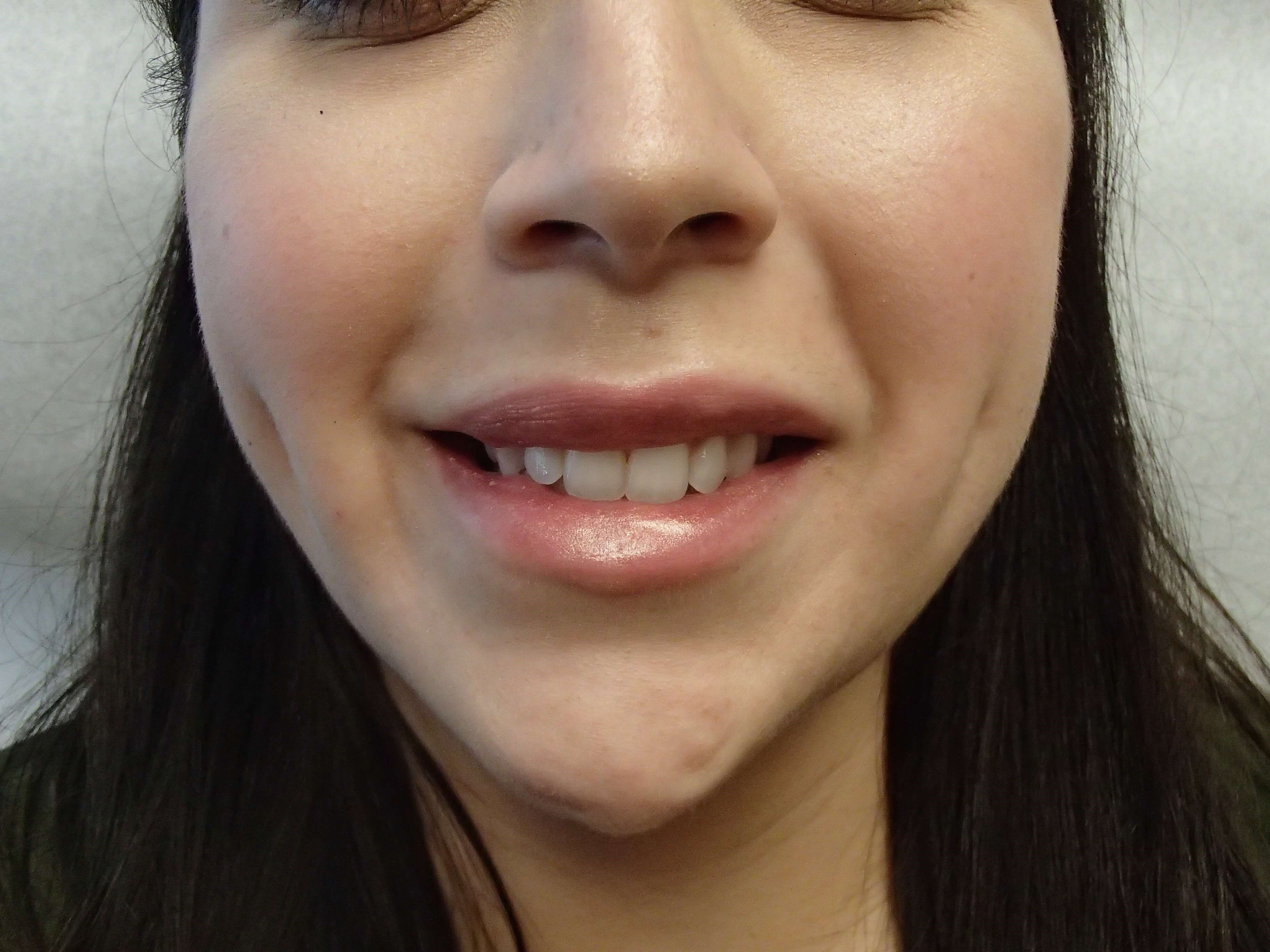 Timeless Dimple After
