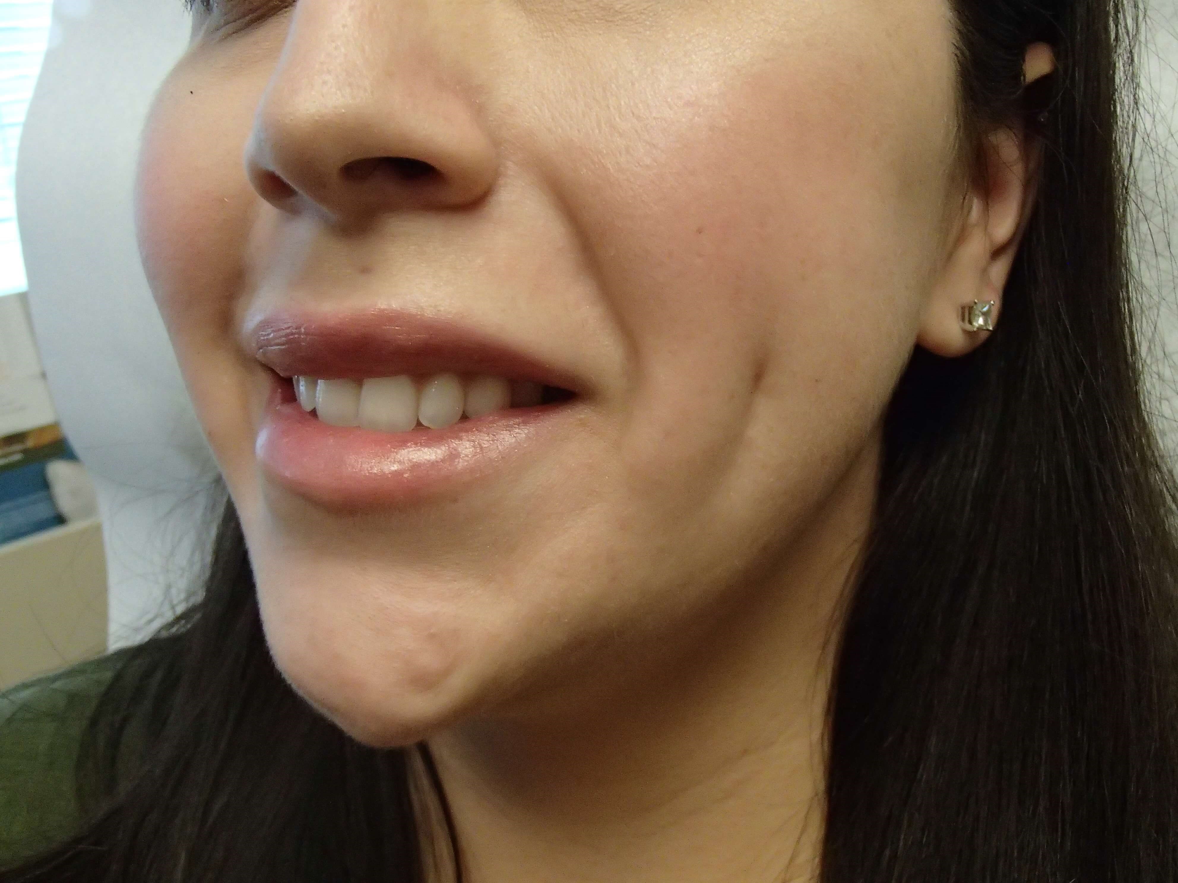 Timeless Dimple After