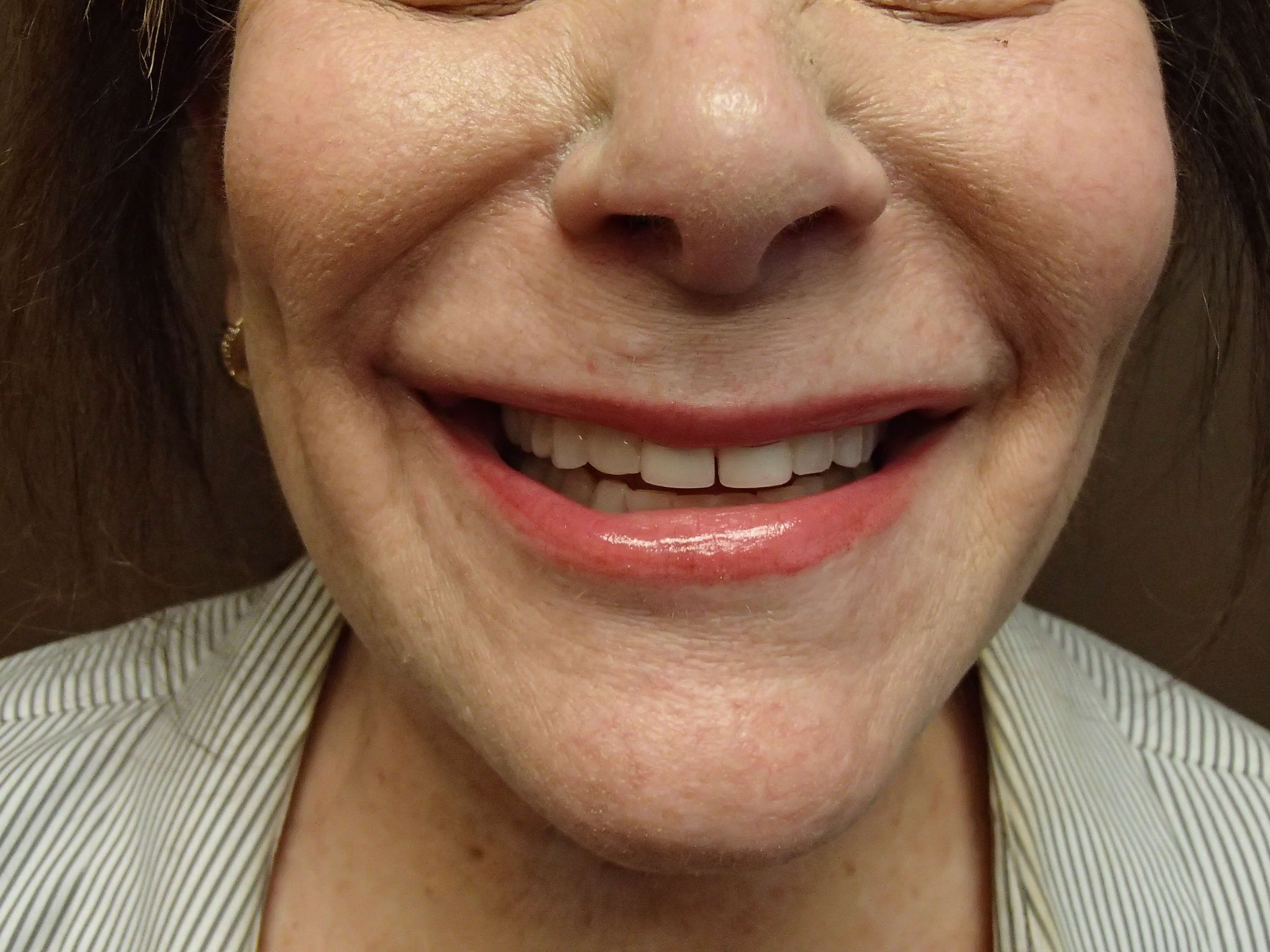 Timeless Dimple After