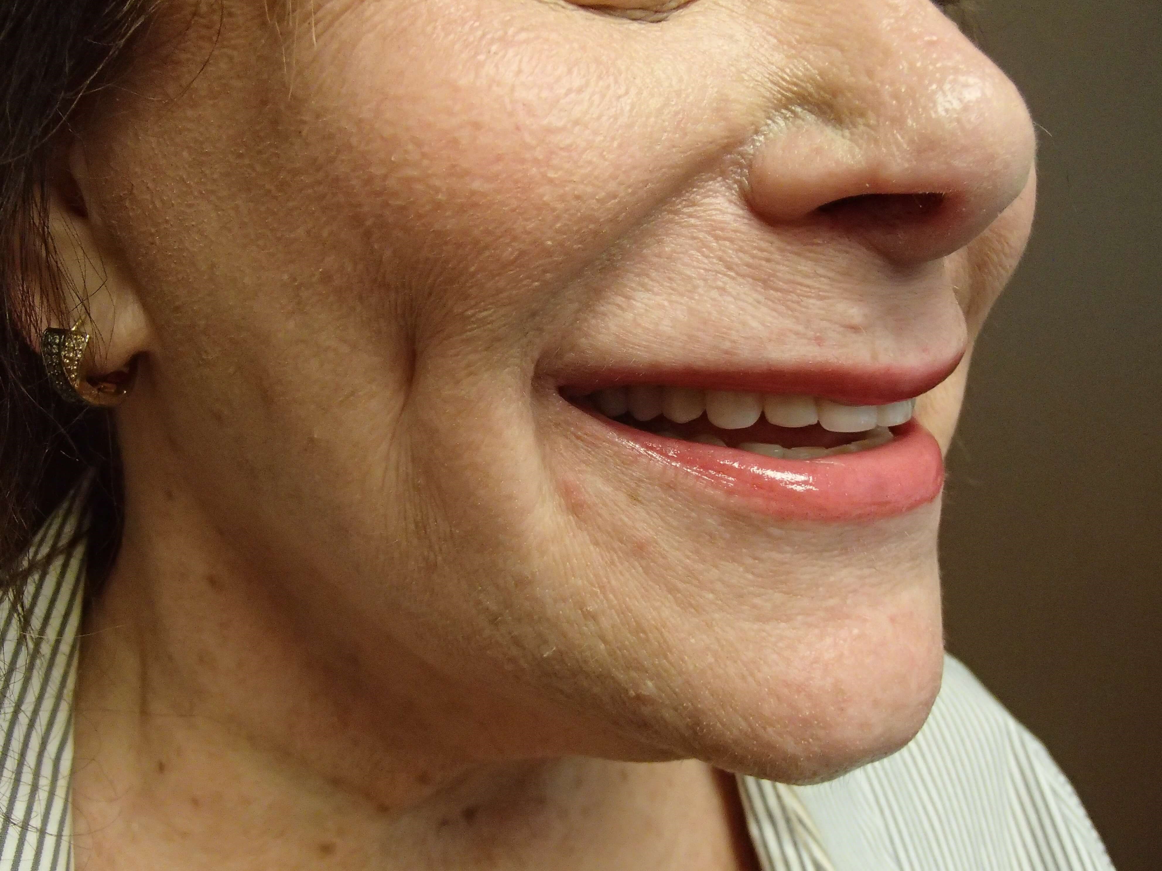 Timeless Dimple After