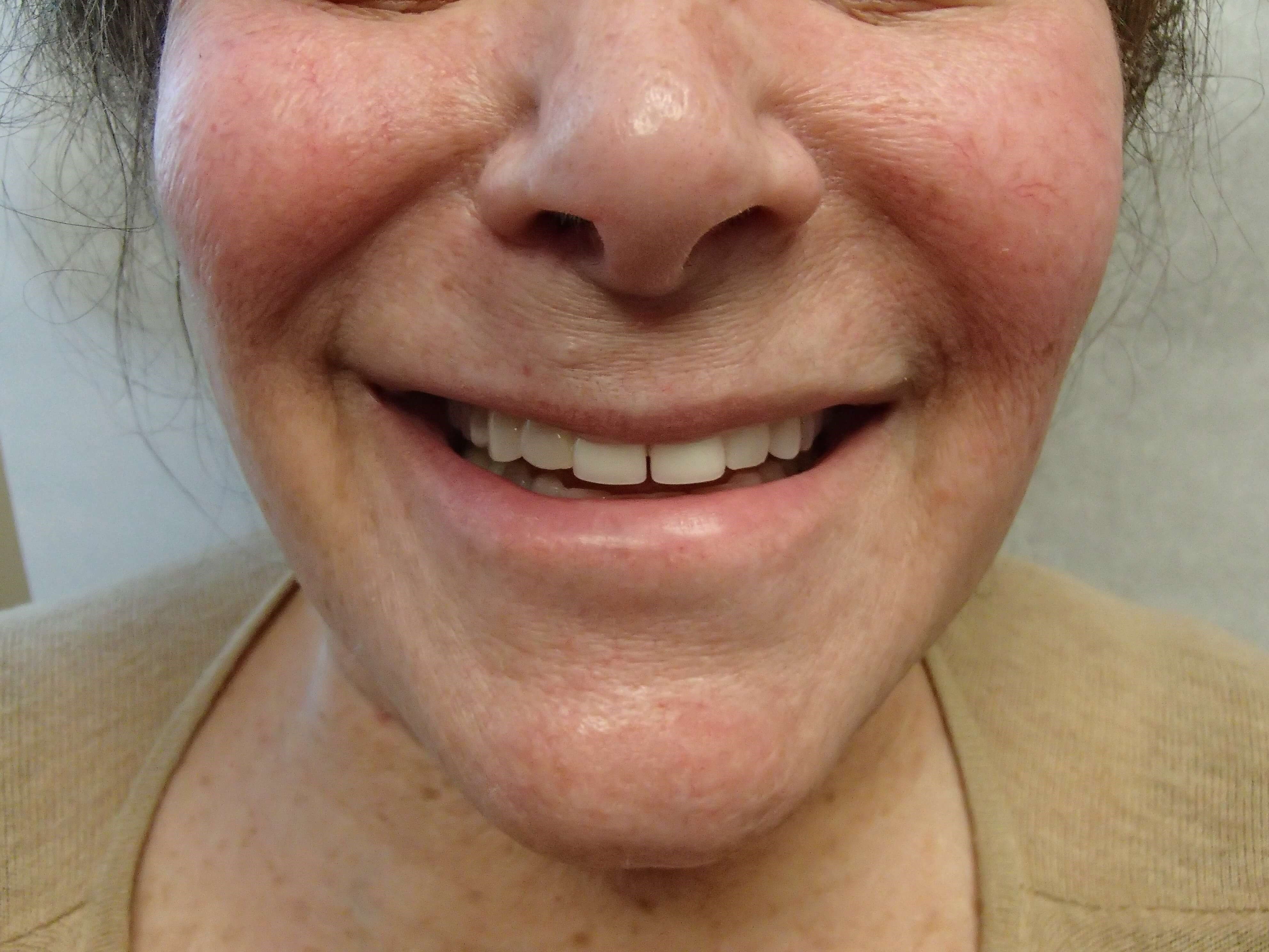 Timeless Dimple Before