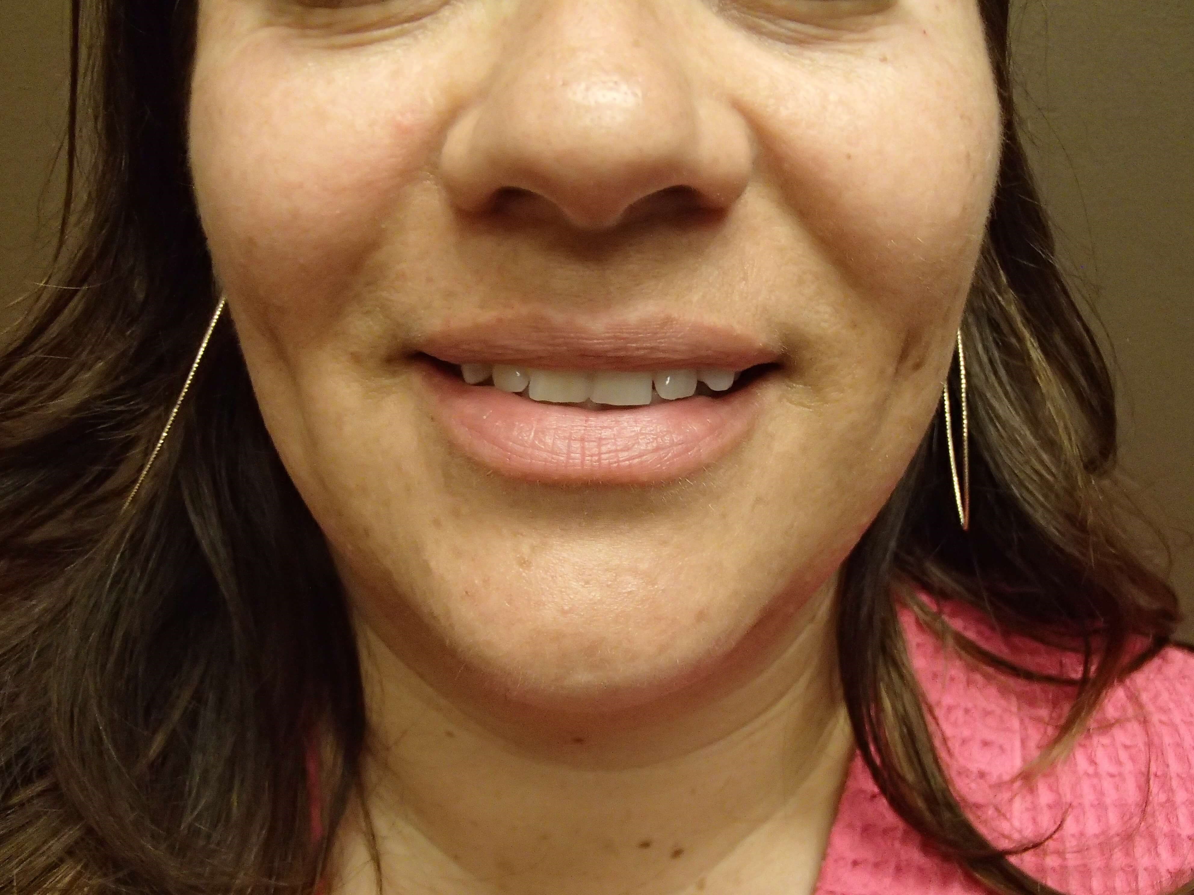 Timeless Dimple After